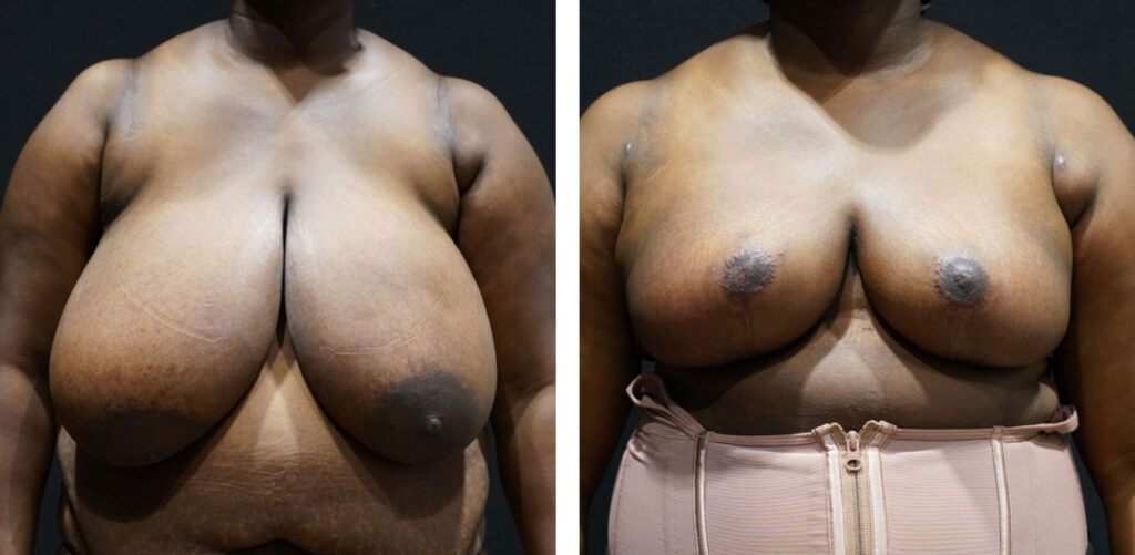 Free Nipple Graft Breast Reduction Before & After Photos