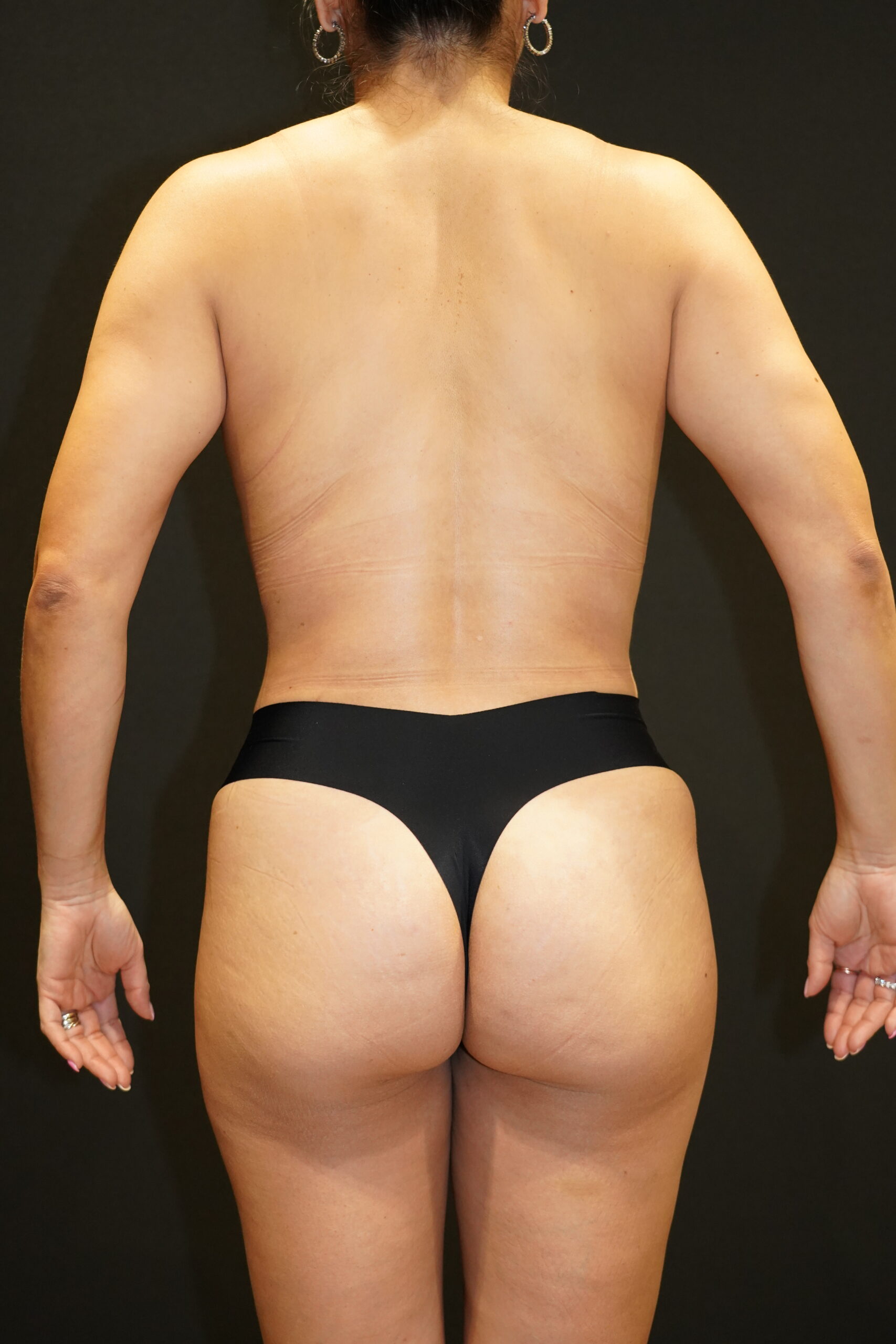 After photo -180° view