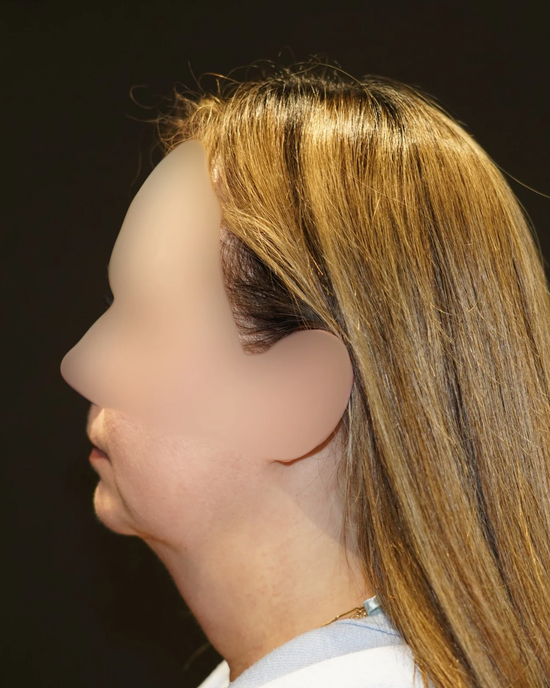 Case--1148 | Before Submentoplasty & Neck