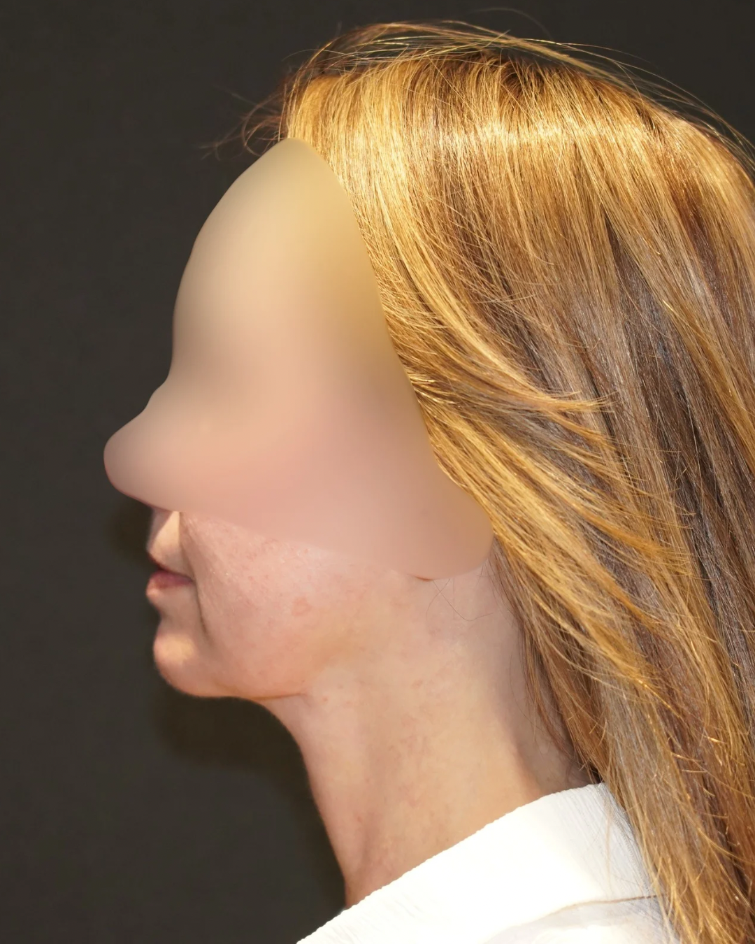 Case--1148 | After Submentoplasty & Neck