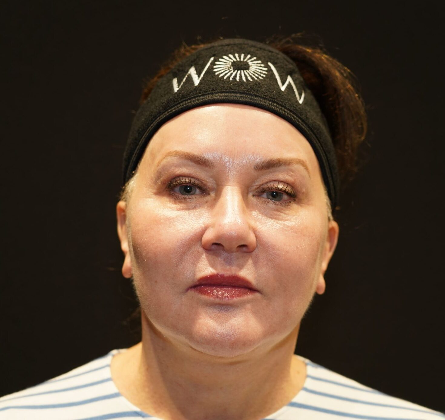 After photo - 0° view