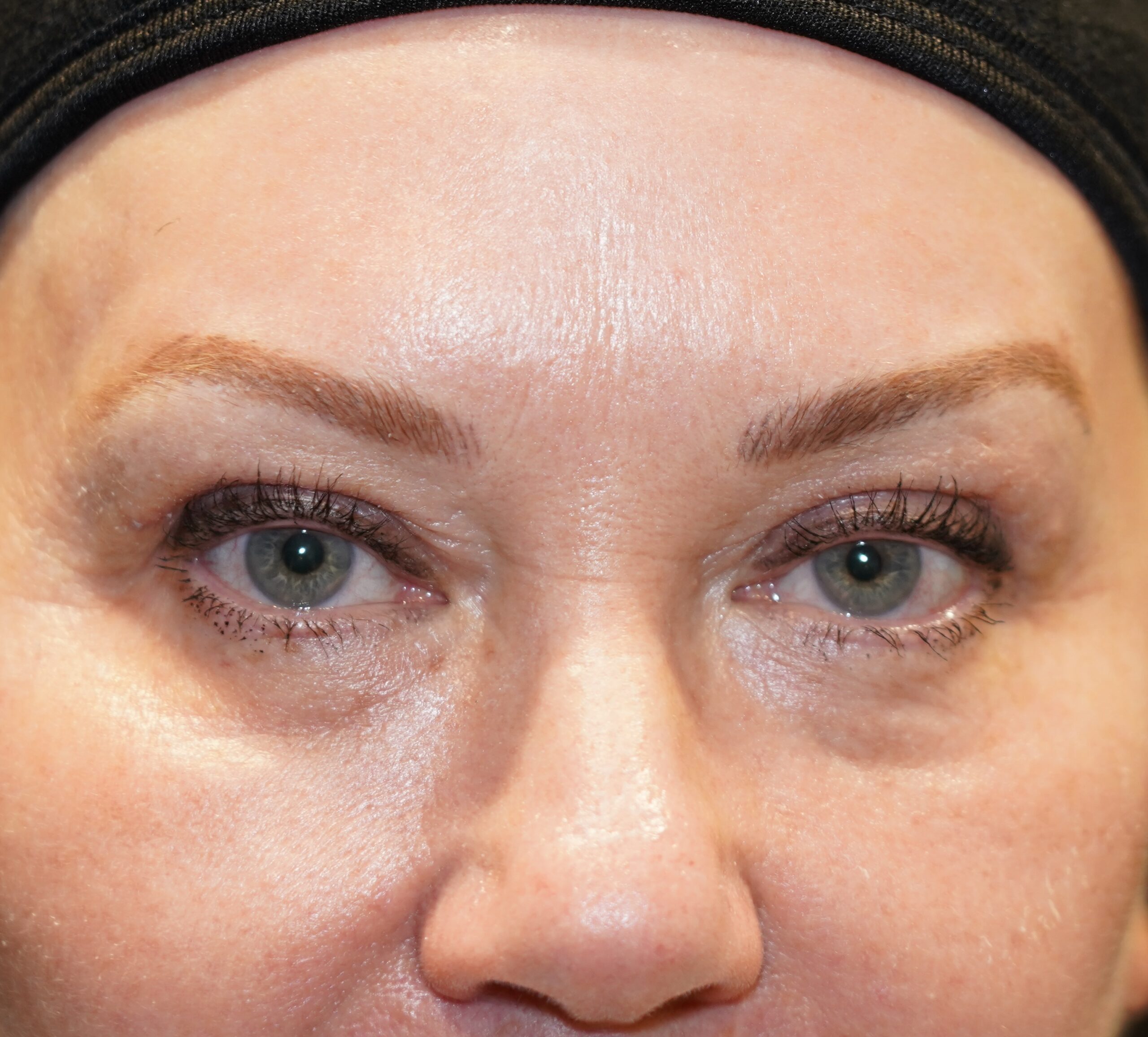 After photo - 0° view