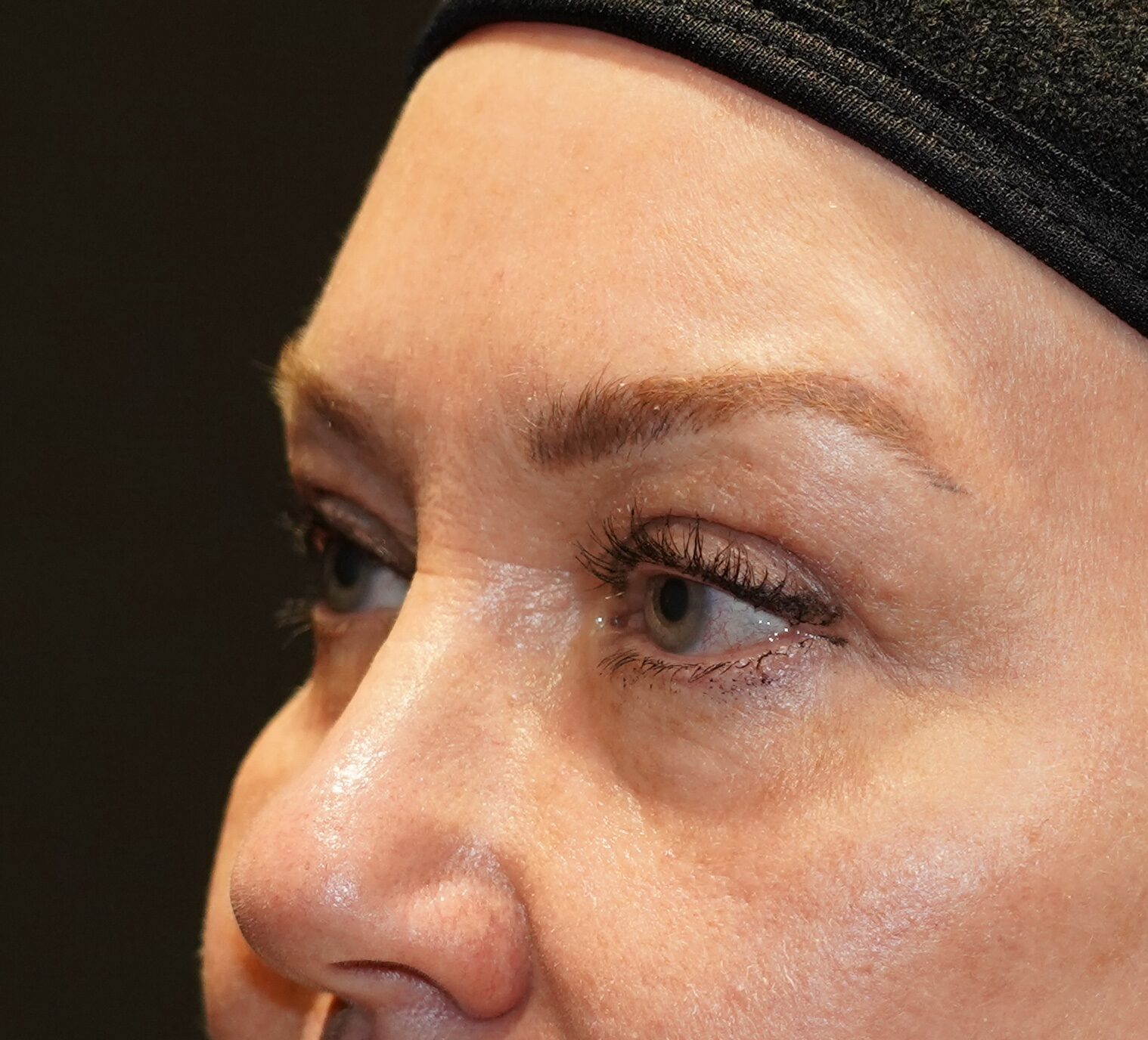 After photo - -45° view