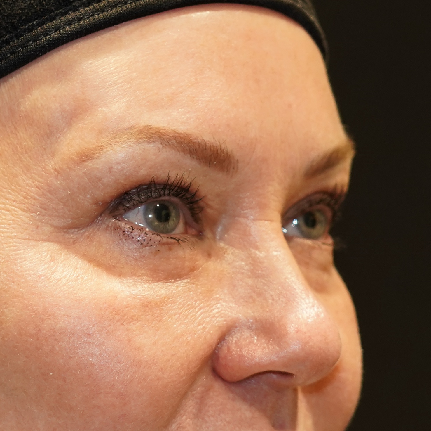 After photo - 45° view