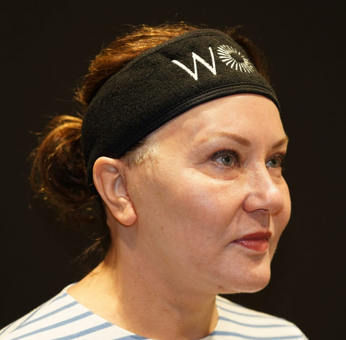 After photo - 45° view