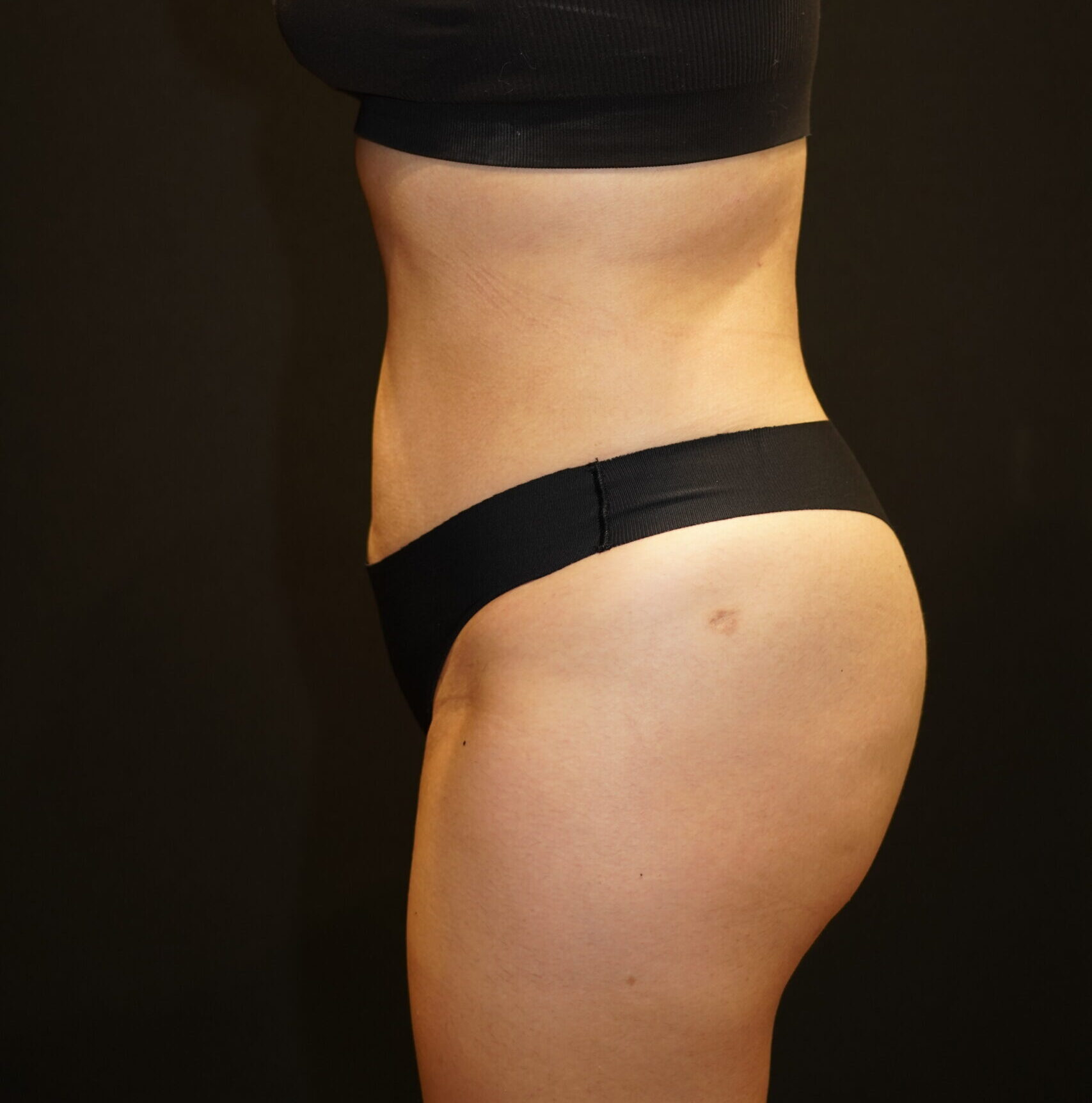 After photo - -90° view