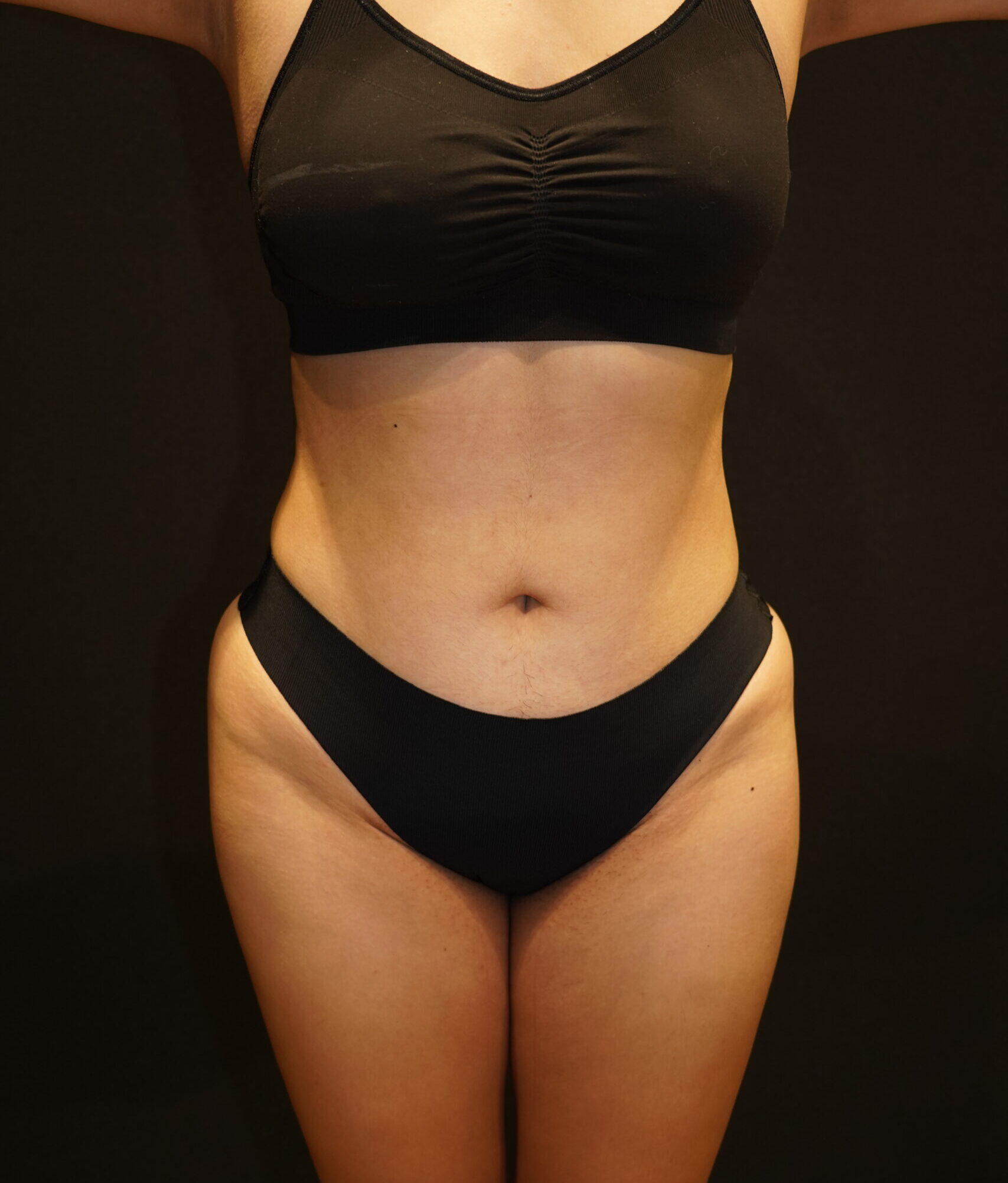 After photo - 0° view