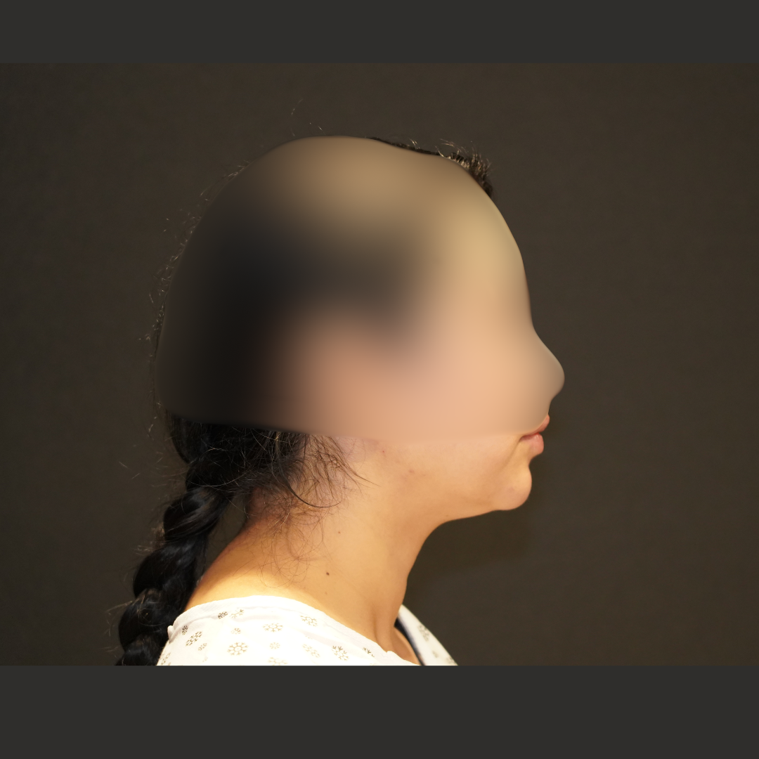 Case--9941 | Before Submentoplasty & Neck 1