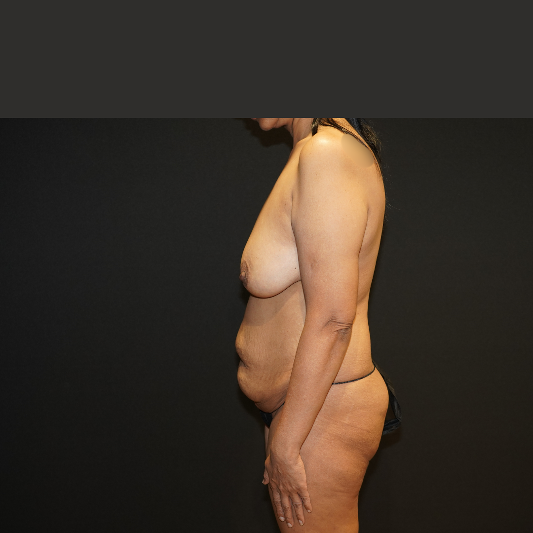 Case--6820 | Before Breast Lift/Mastopexy 1