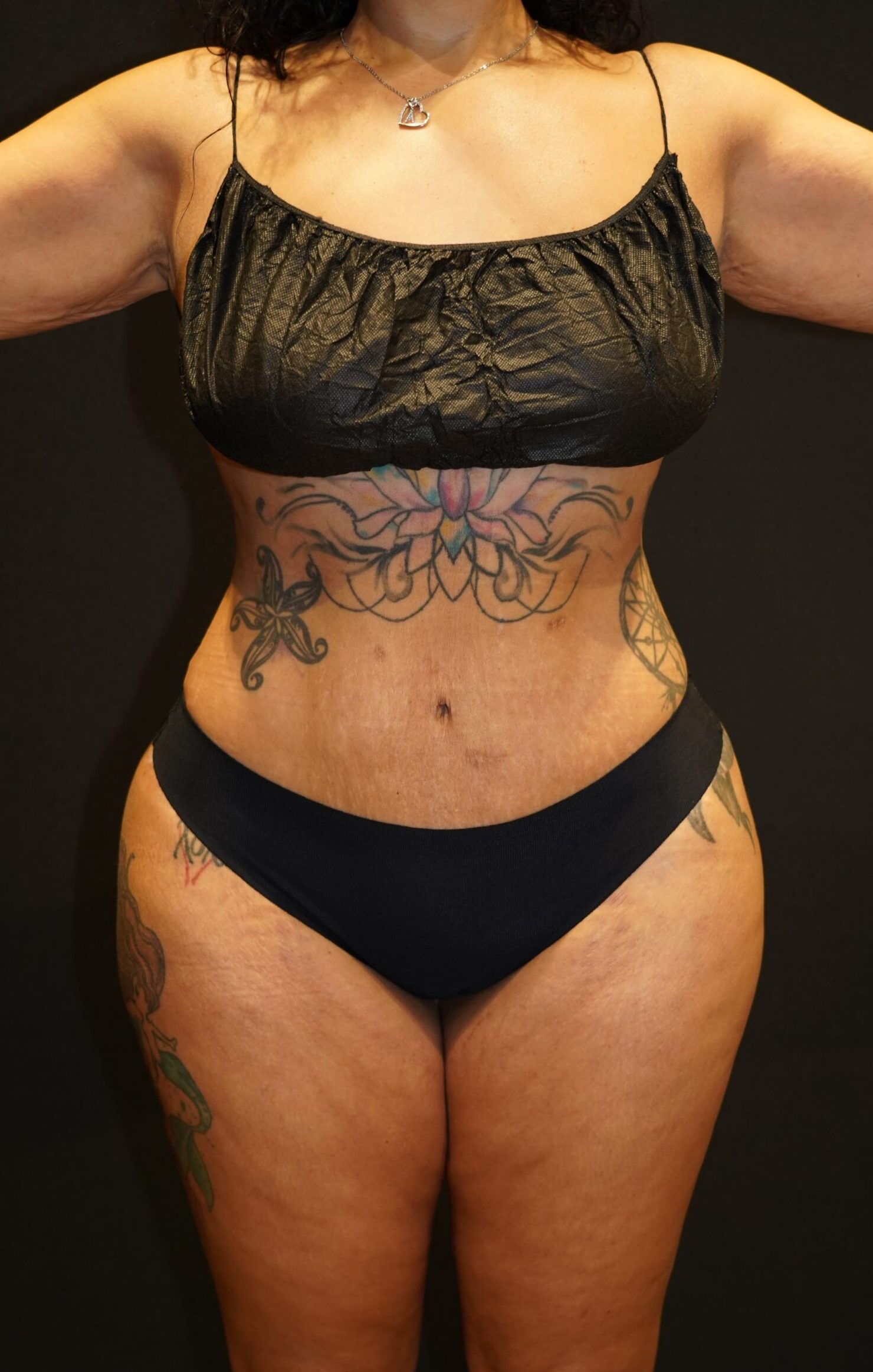 After photo - 0° view