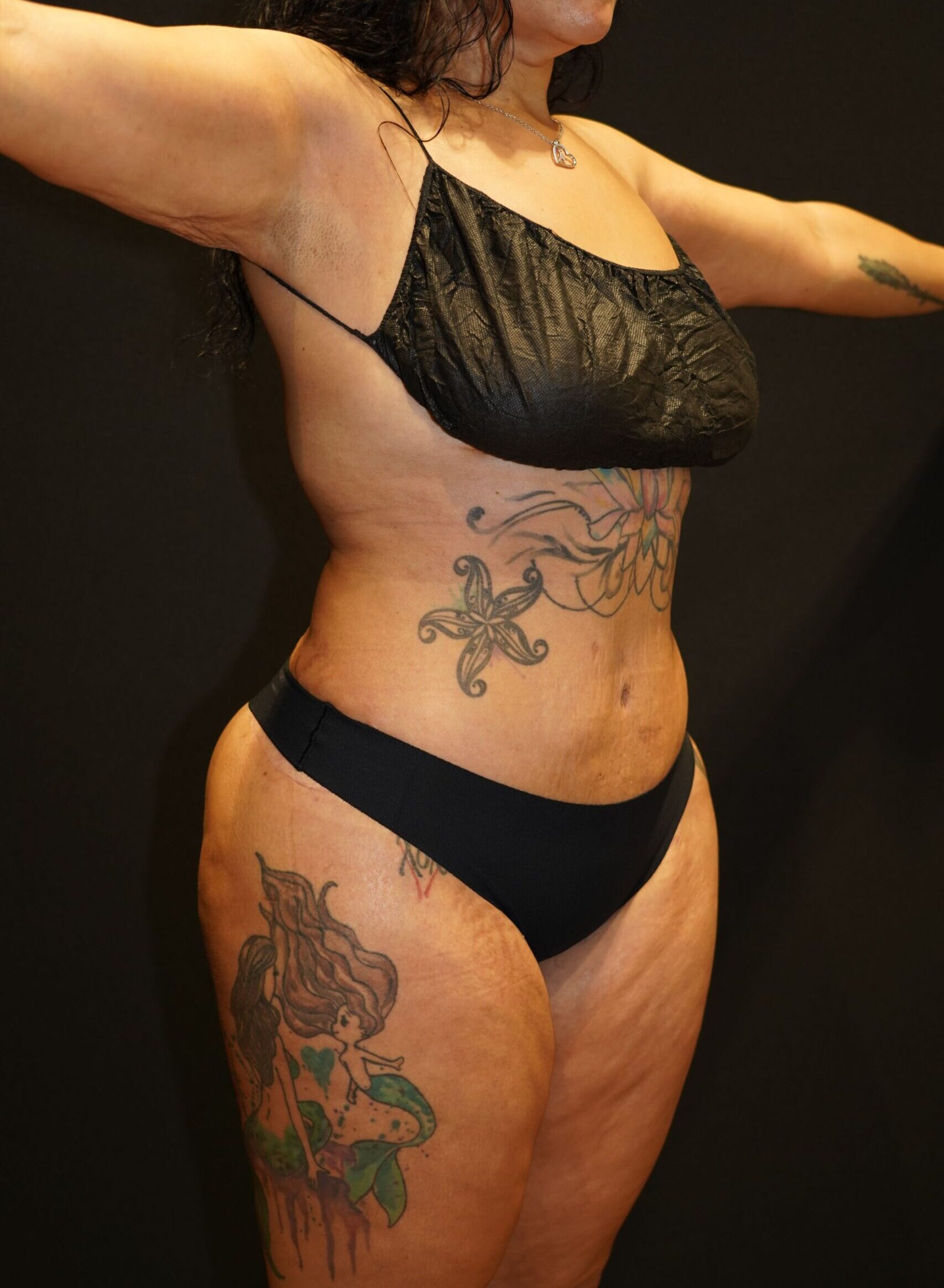 After photo - 45° view