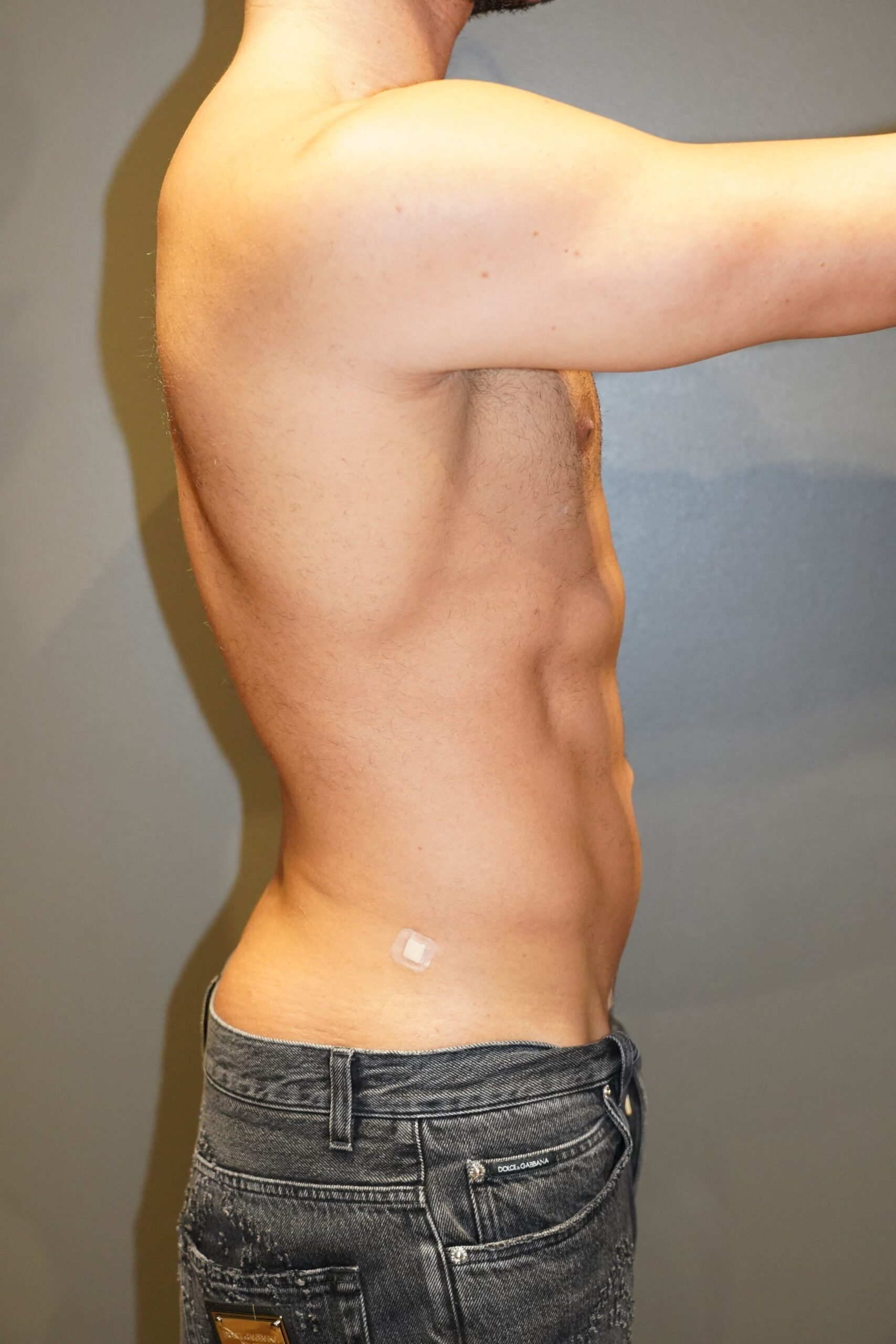 After photo - 90° view