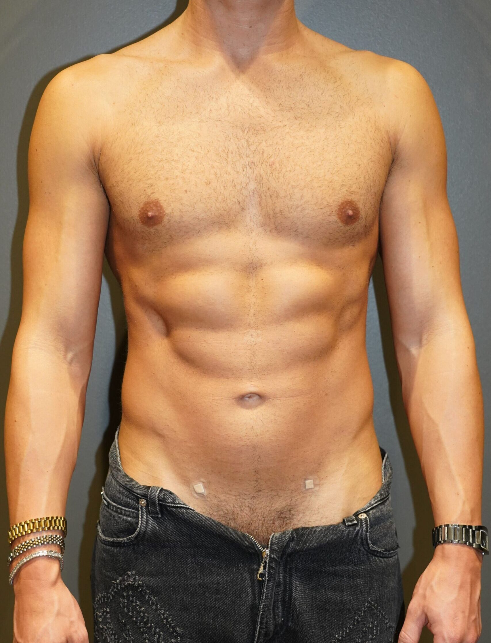 After photo - 0° view