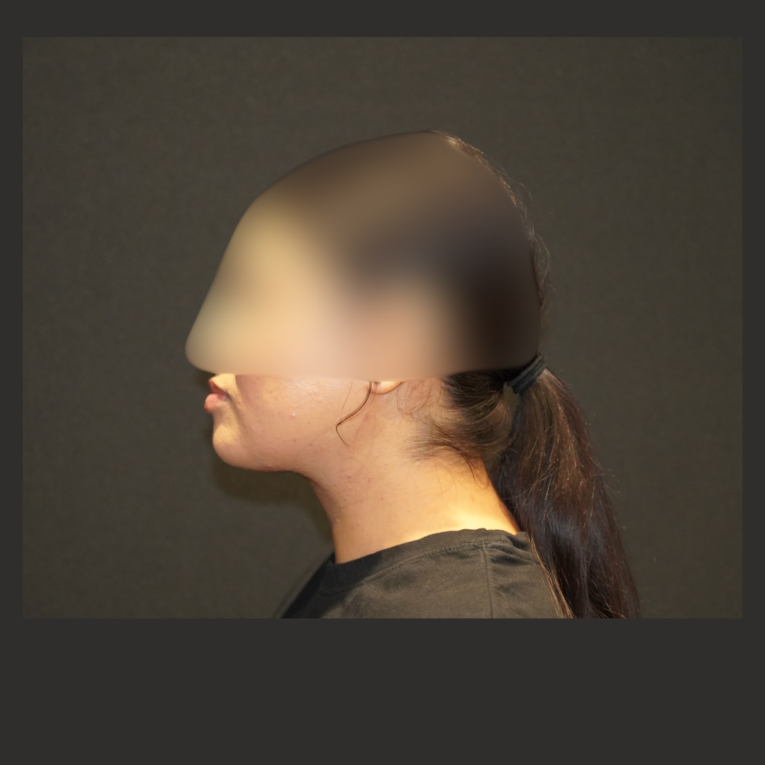 Case--1204 | After Face Procedures
