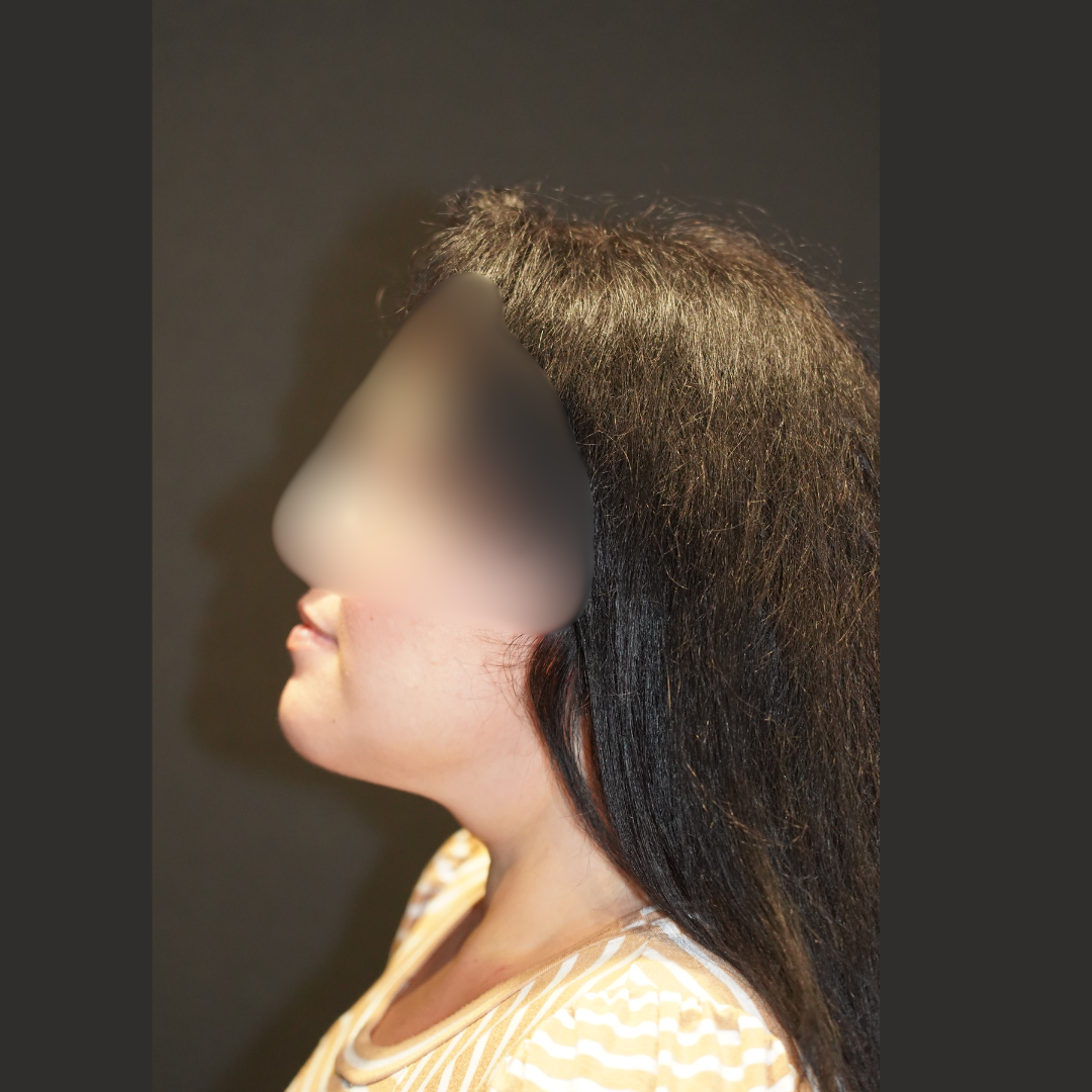 Case--5373 | After Face Procedures