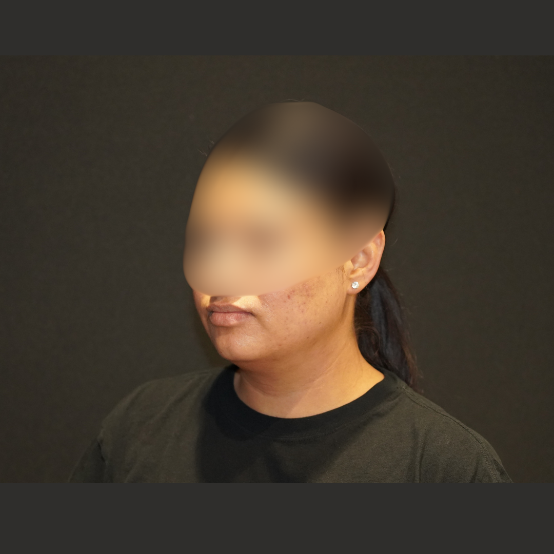 Case--1204 | Before Submentoplasty & Neck 2
