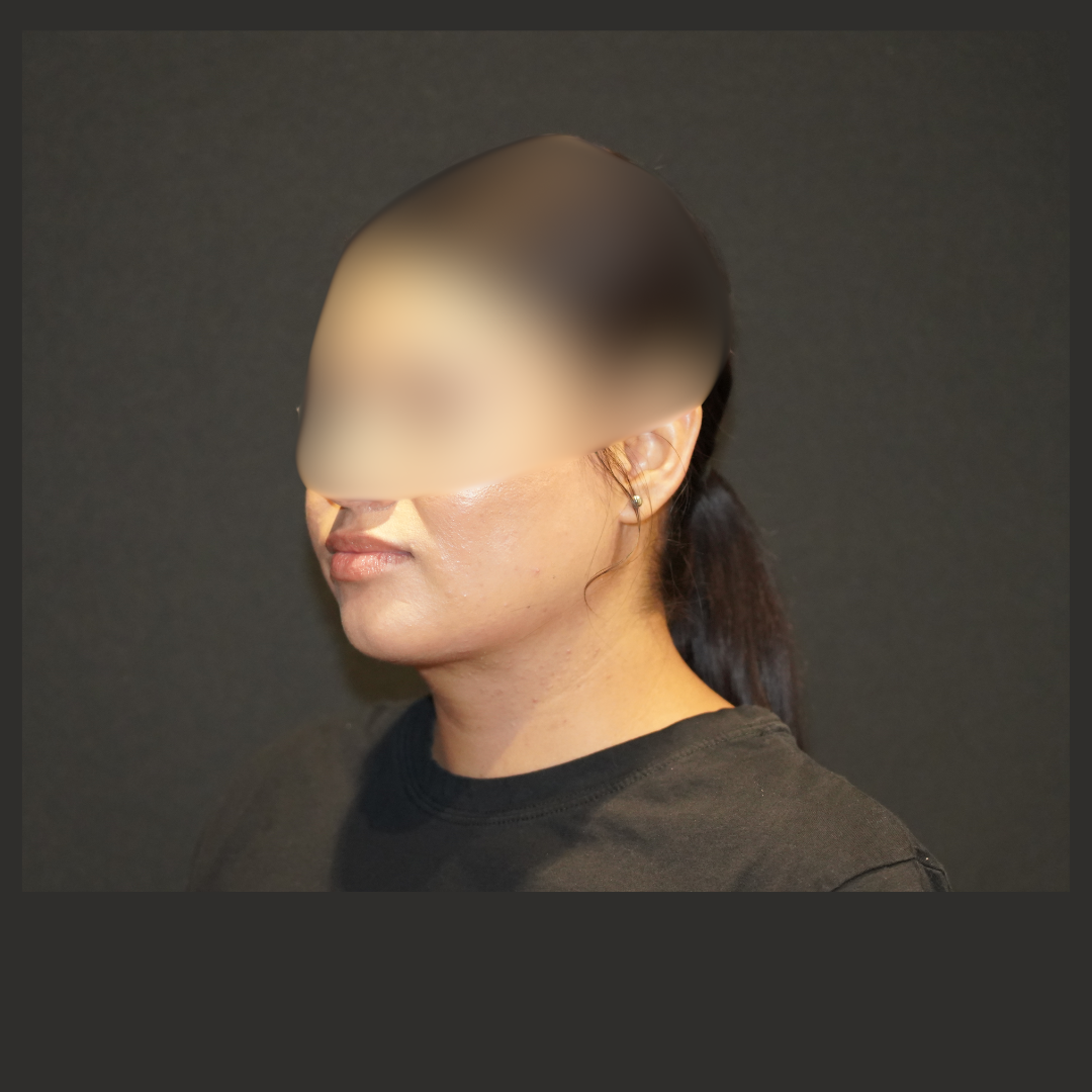 Case--1204 | After Submentoplasty & Neck 2