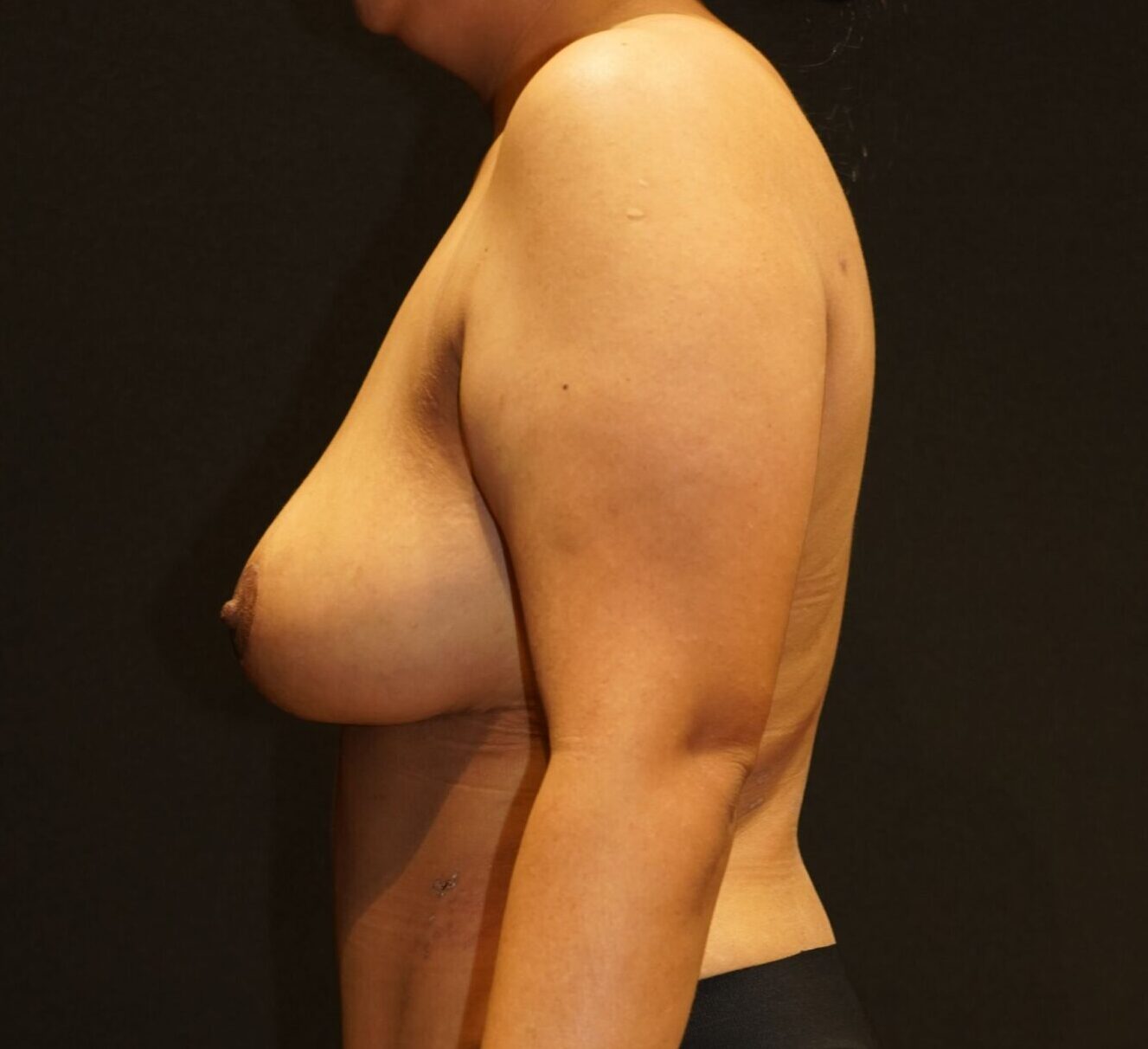 After photo - -90° view