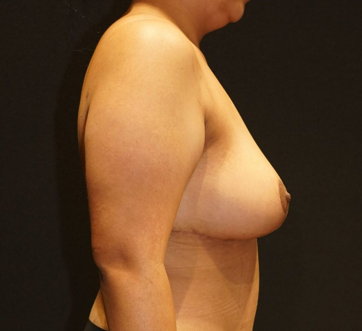 After photo - 90° view