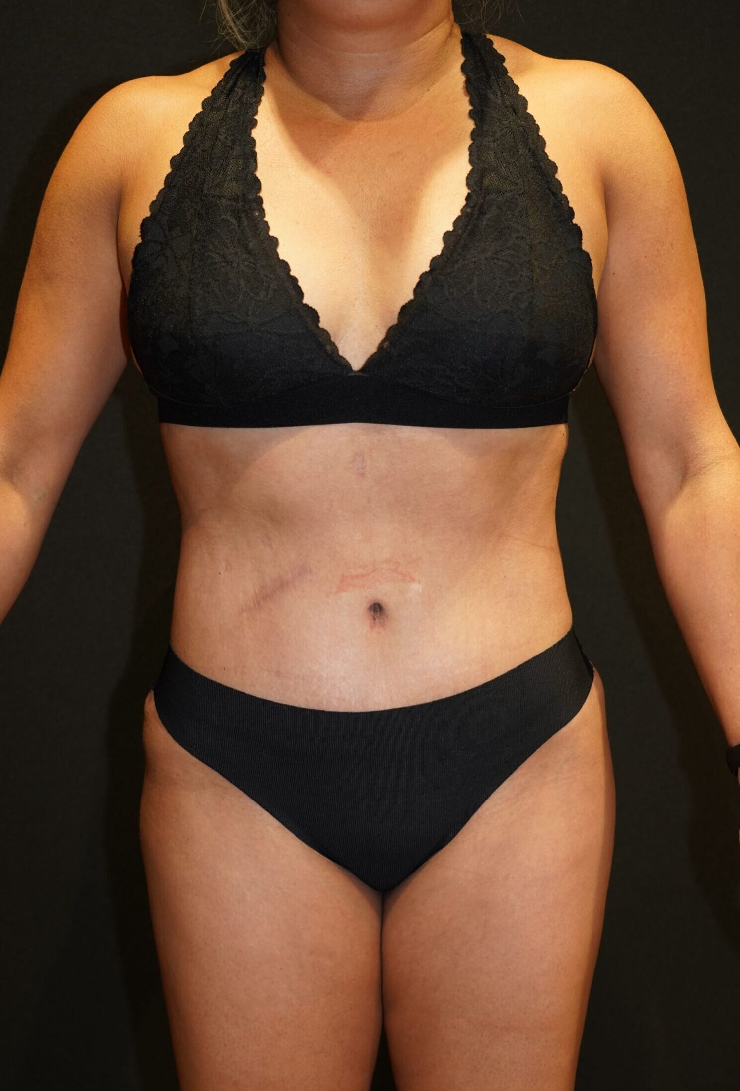 After photo - 0° view