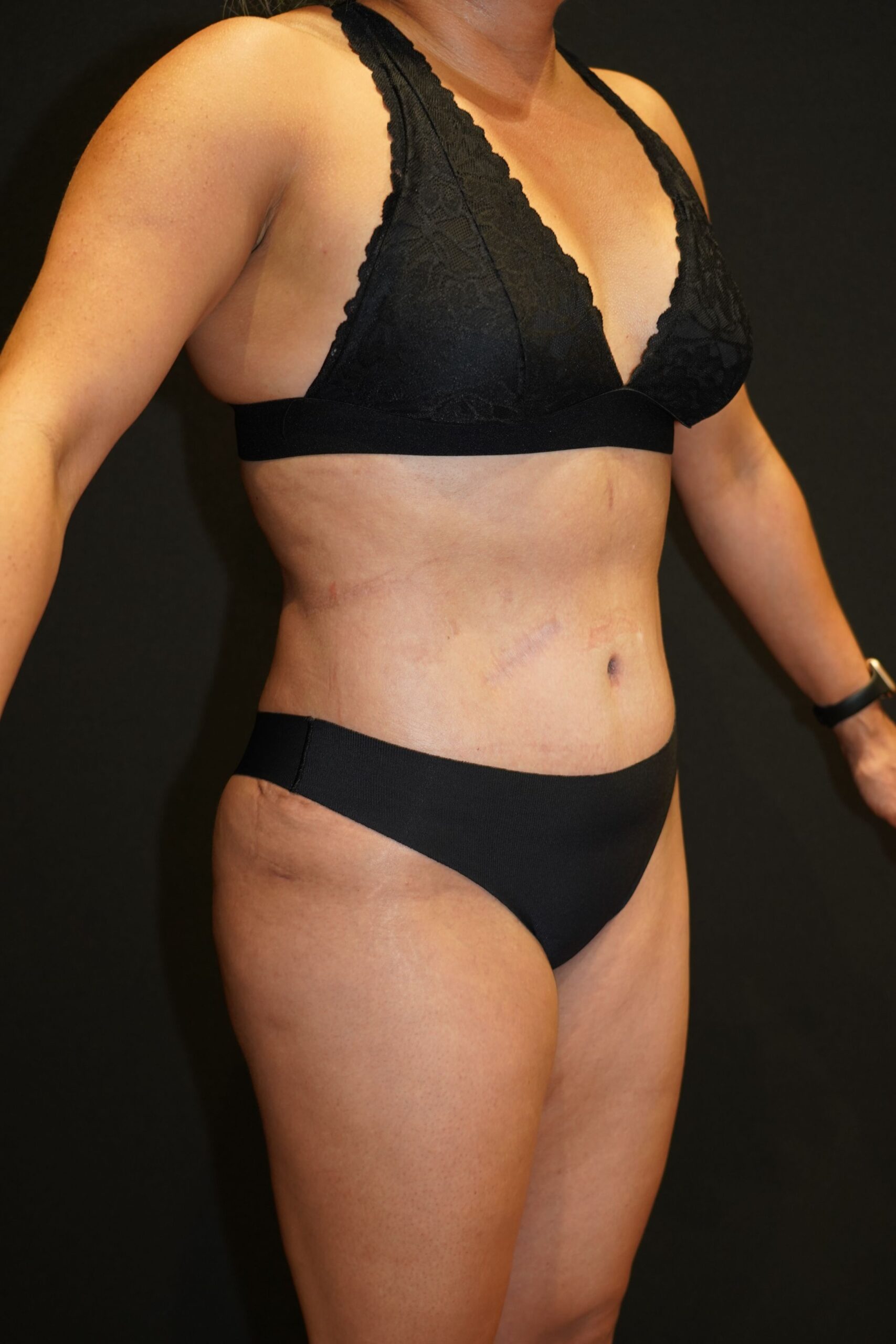 After photo - 45° view