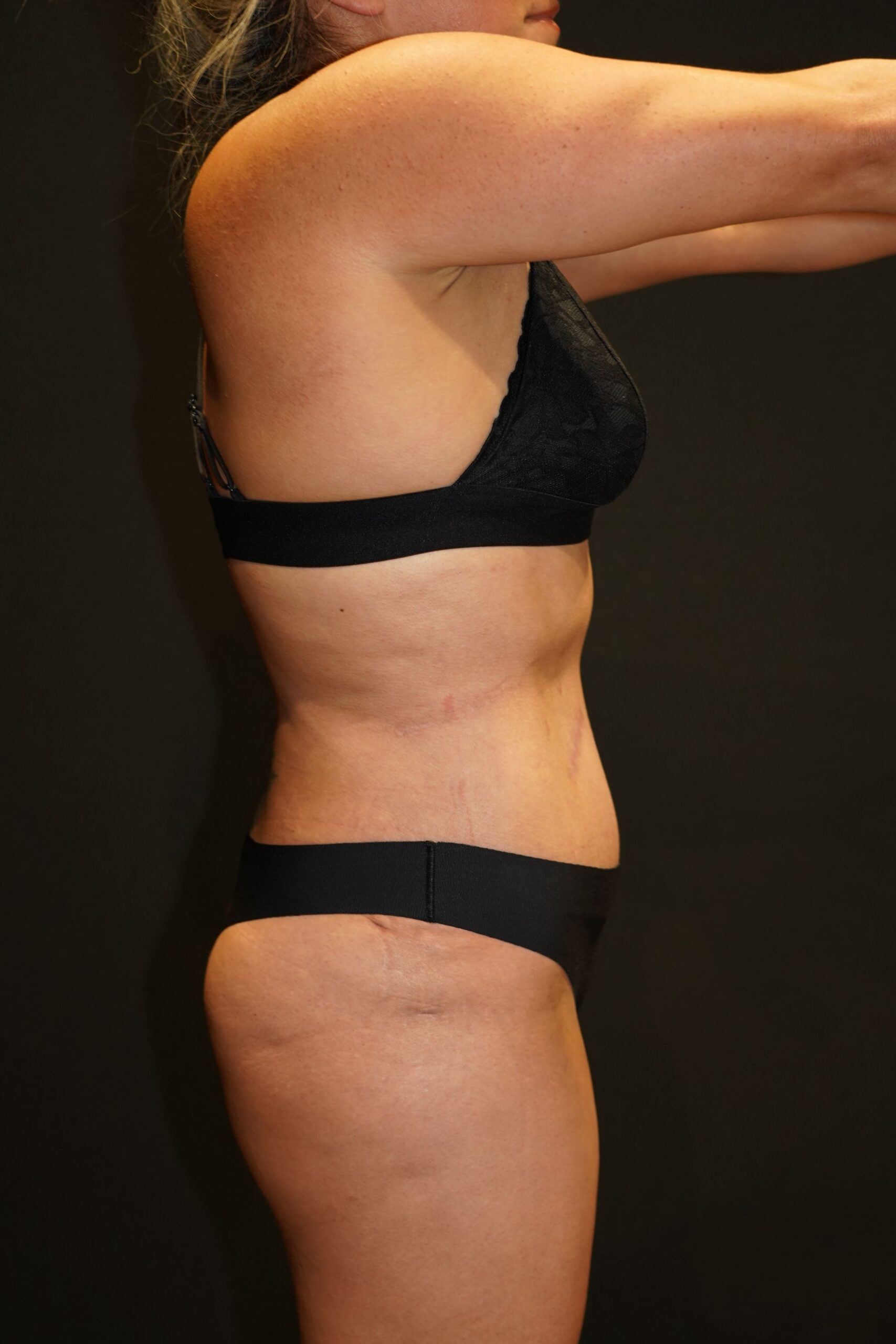 After photo - 90° view