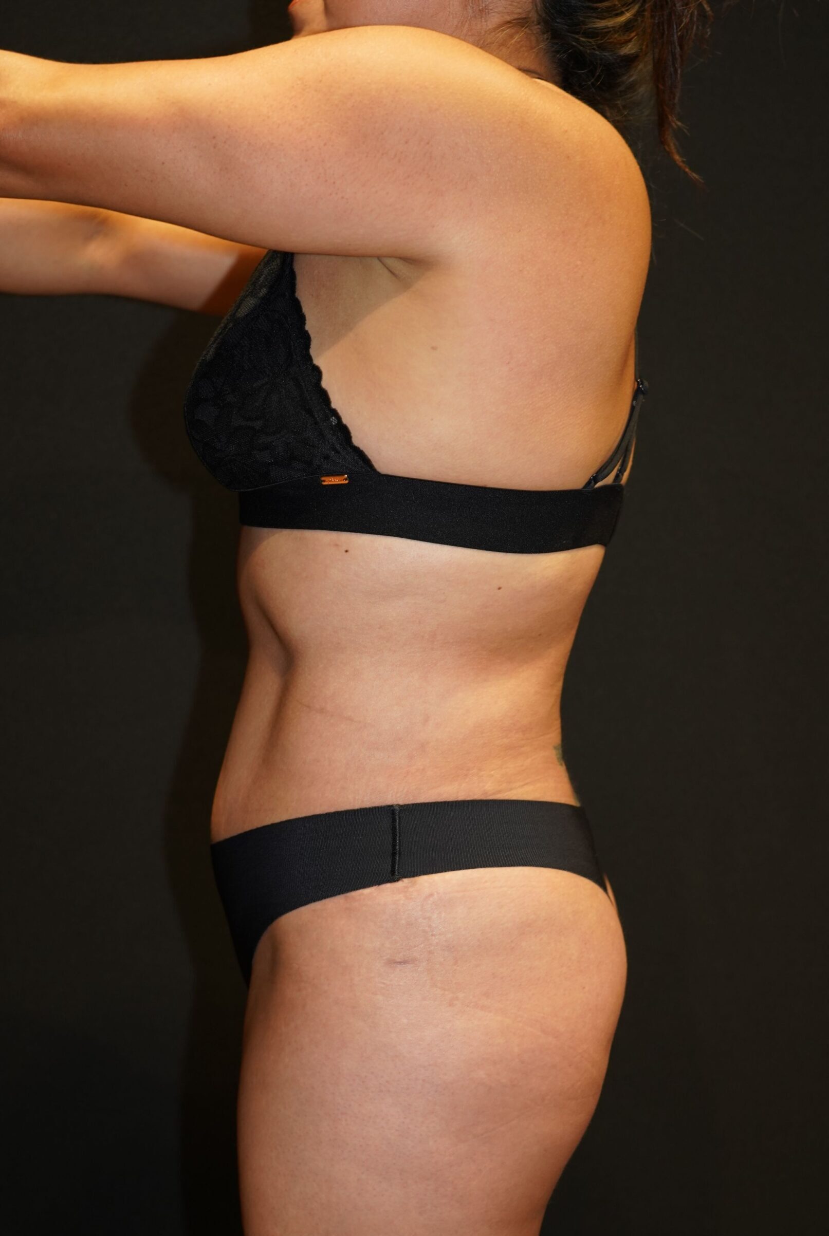 After photo - -90° view