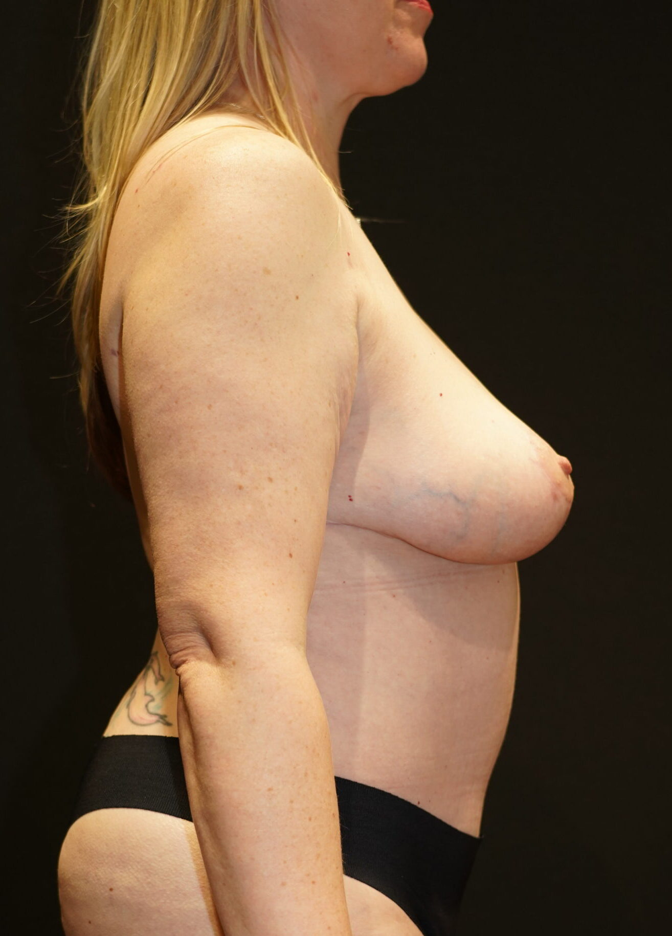 After photo - 90° view