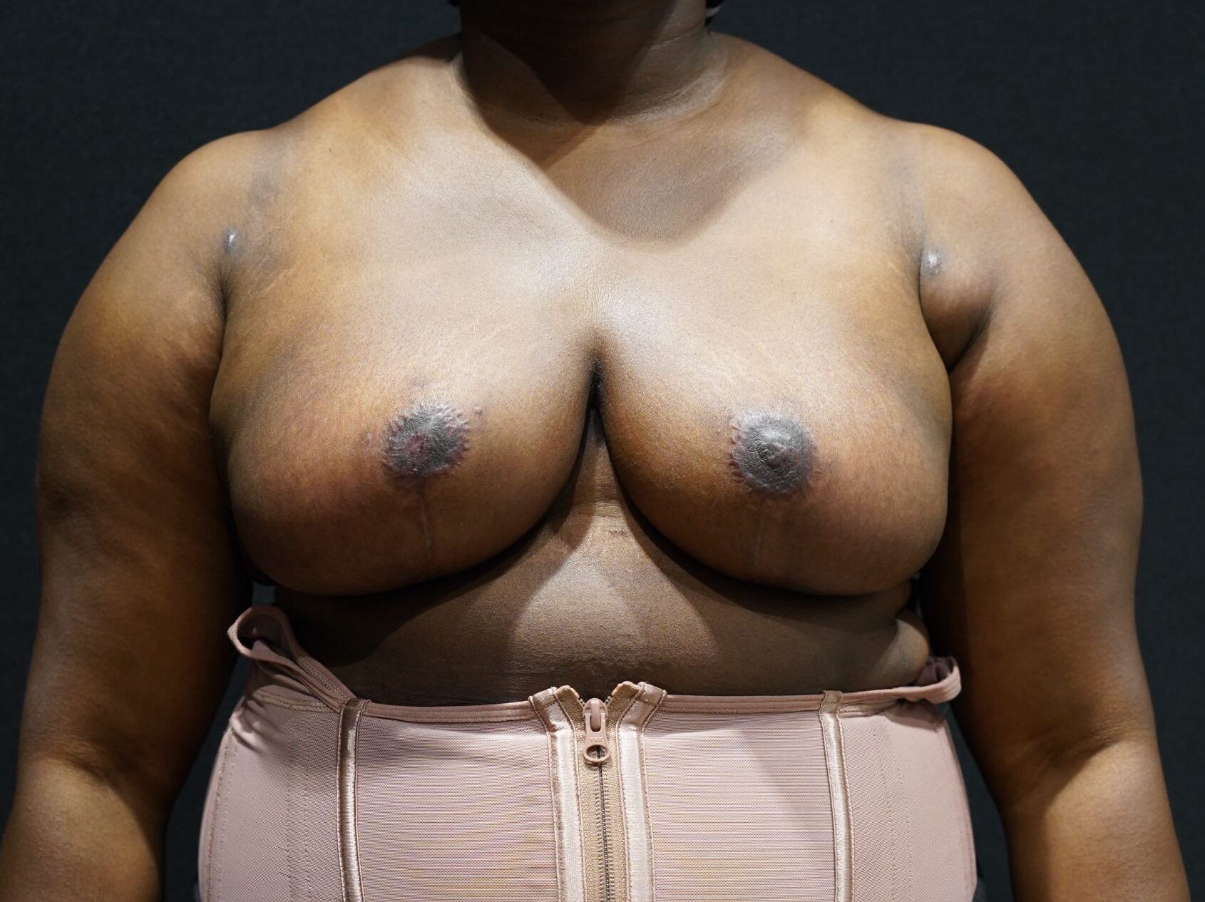 After photo - 0° view