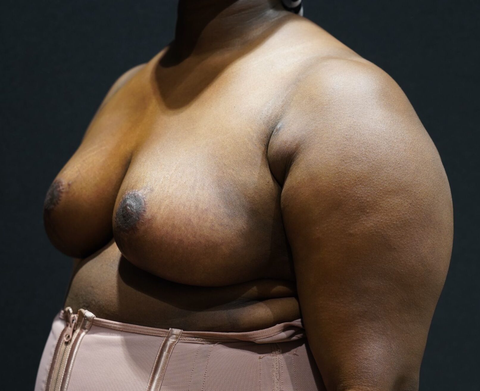 After photo - -45° view