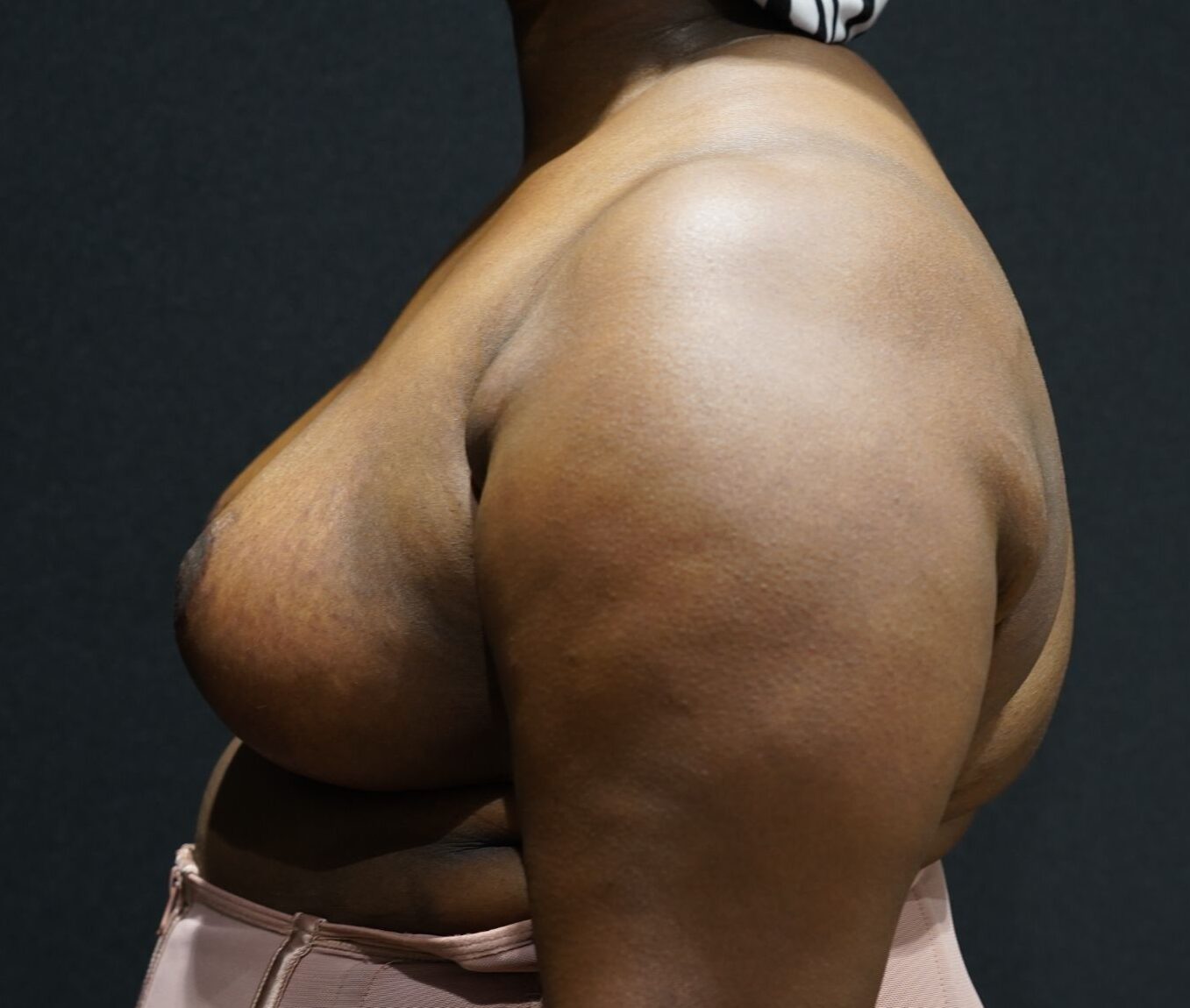 After photo - -90° view