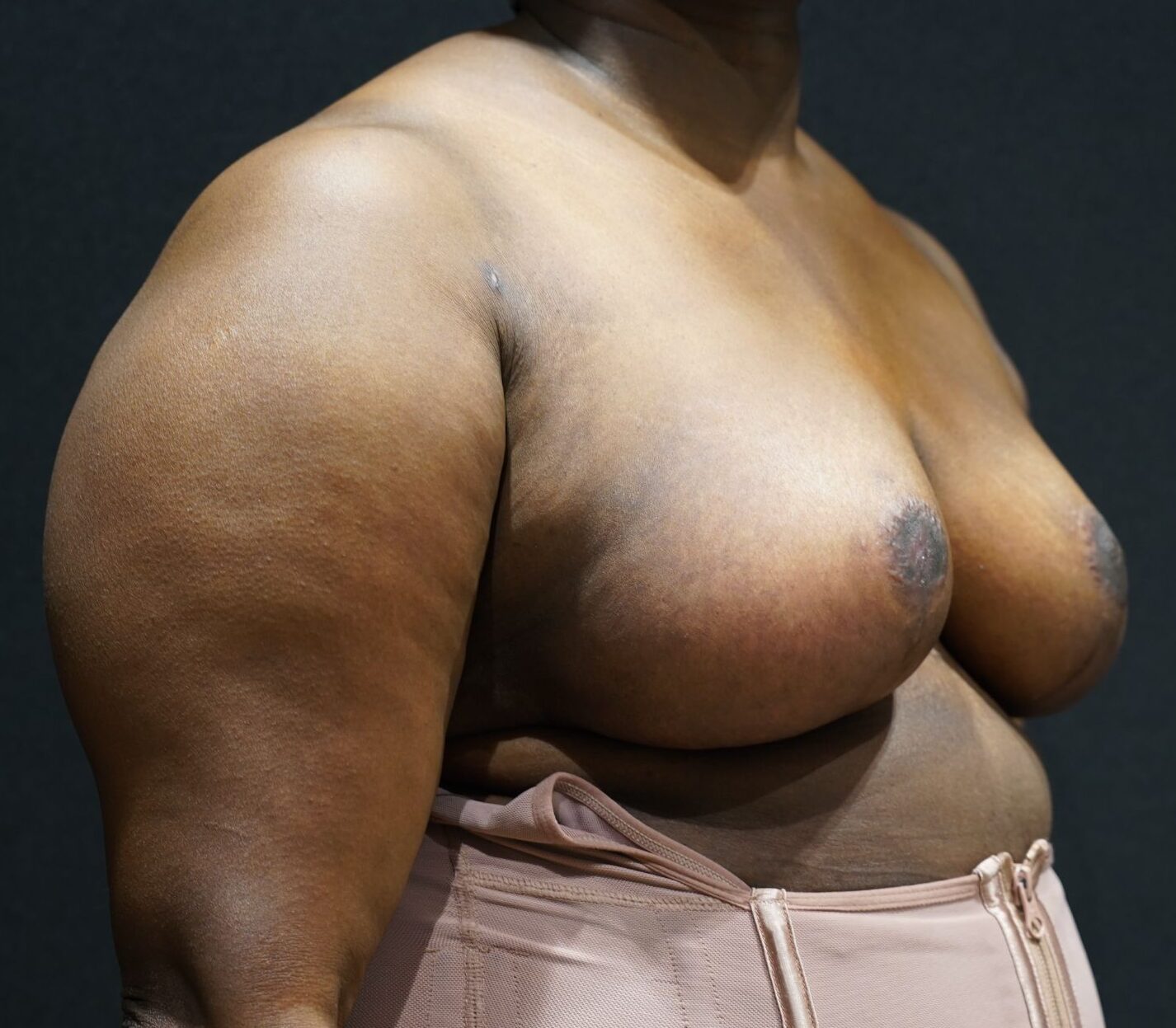 After photo - 45° view