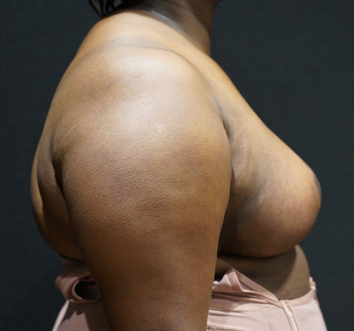 After photo - 90° view