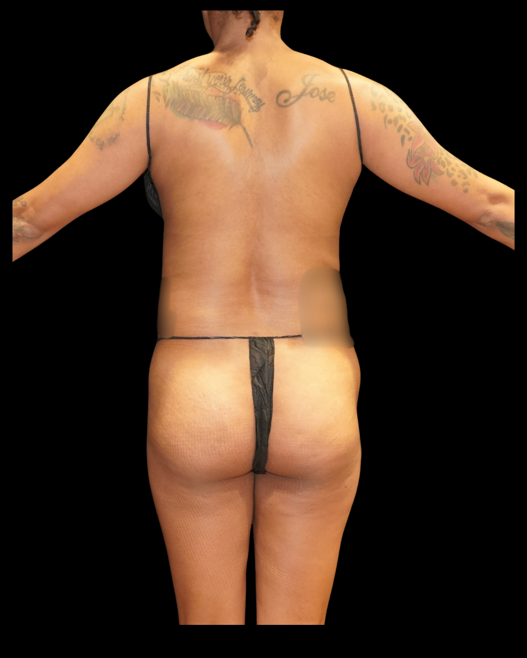 Case--8968 | Before Brazilian Butt Lift