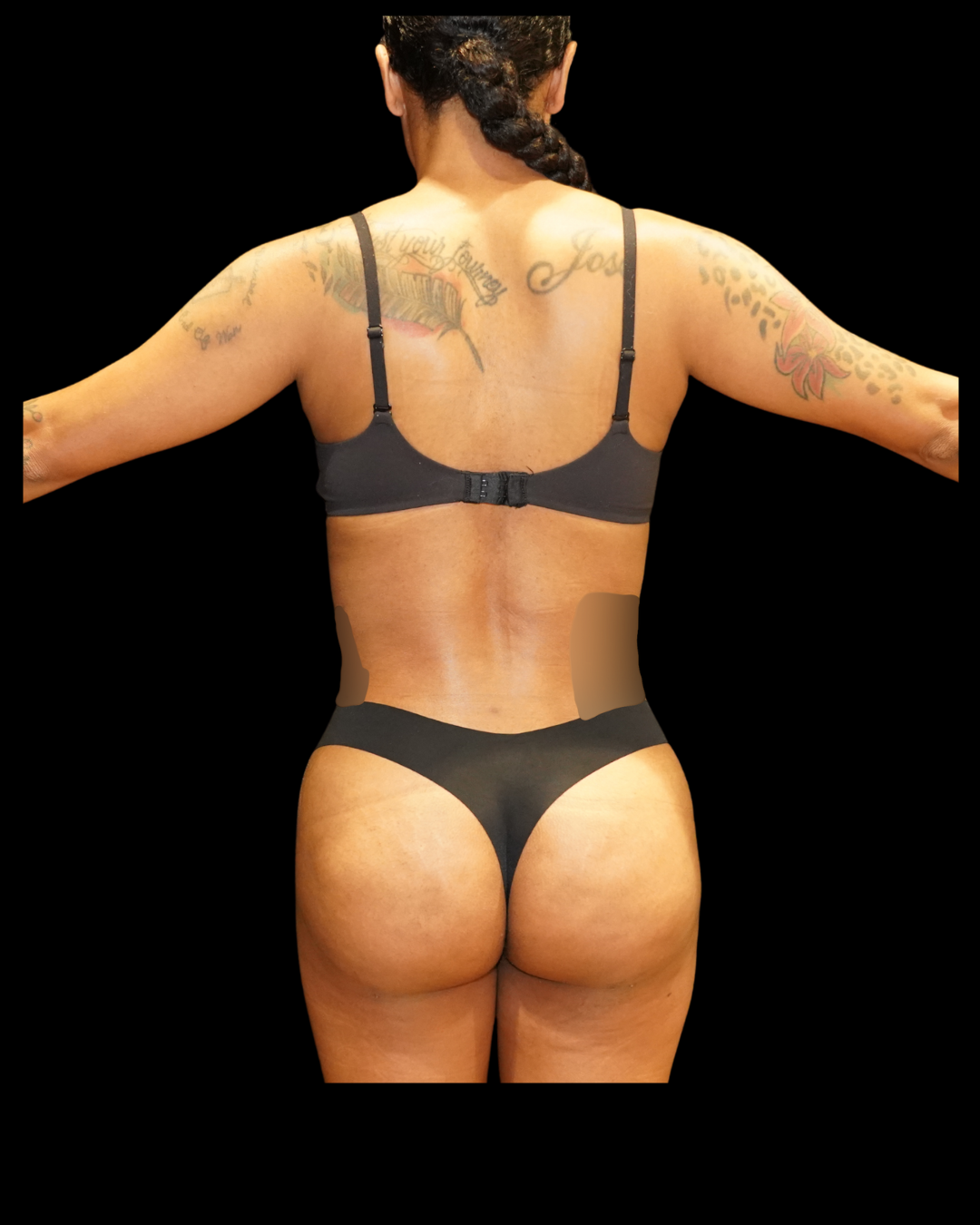Case--8968 | After Brazilian Butt Lift