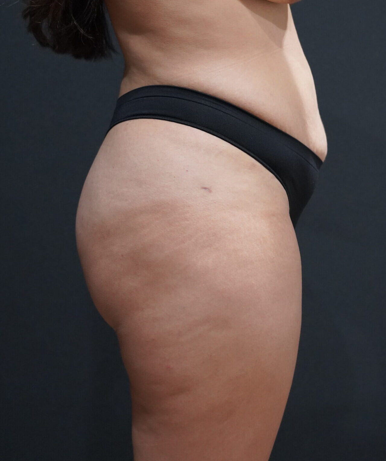 After photo - 90° view