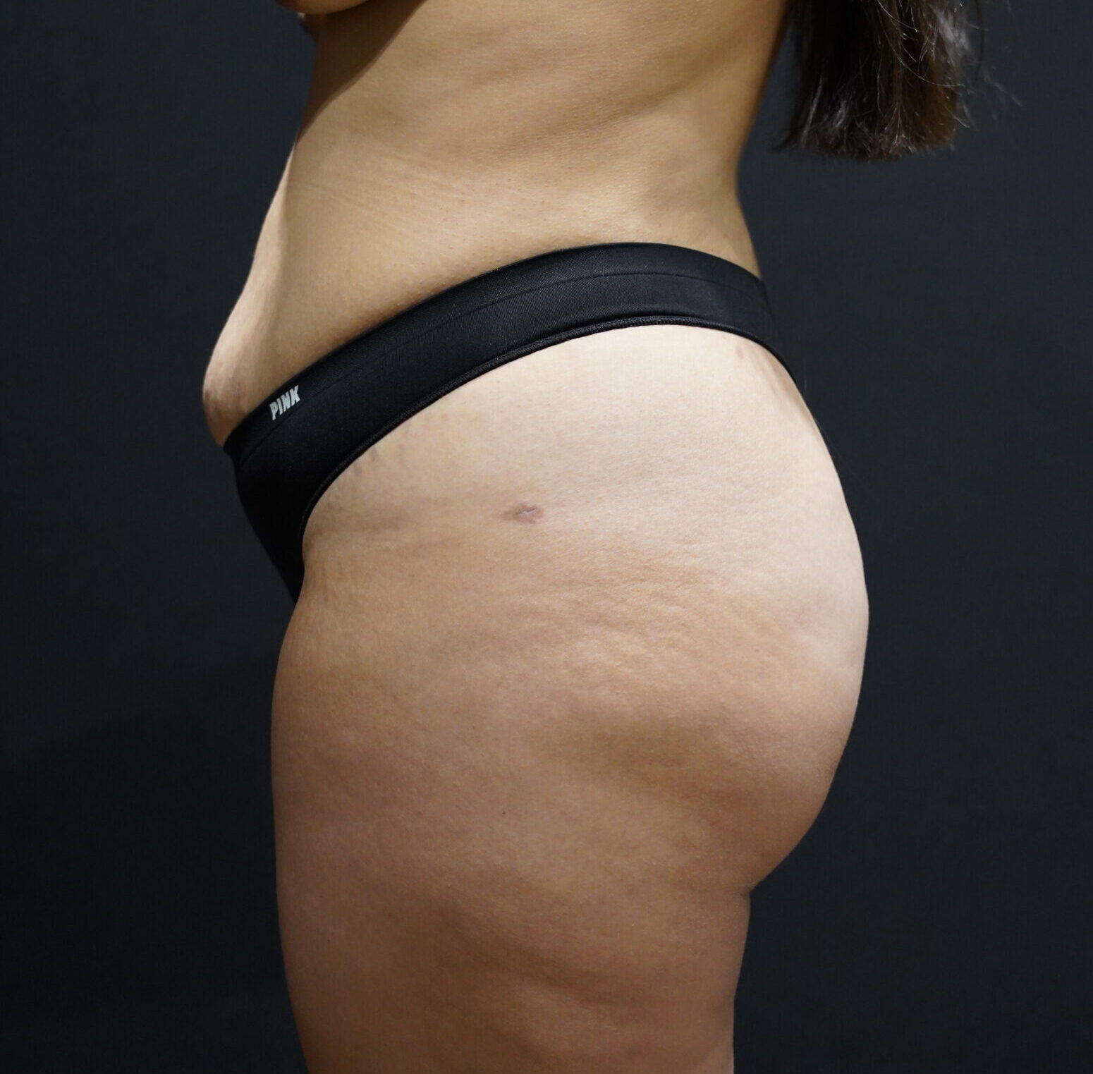 After photo - -90° view