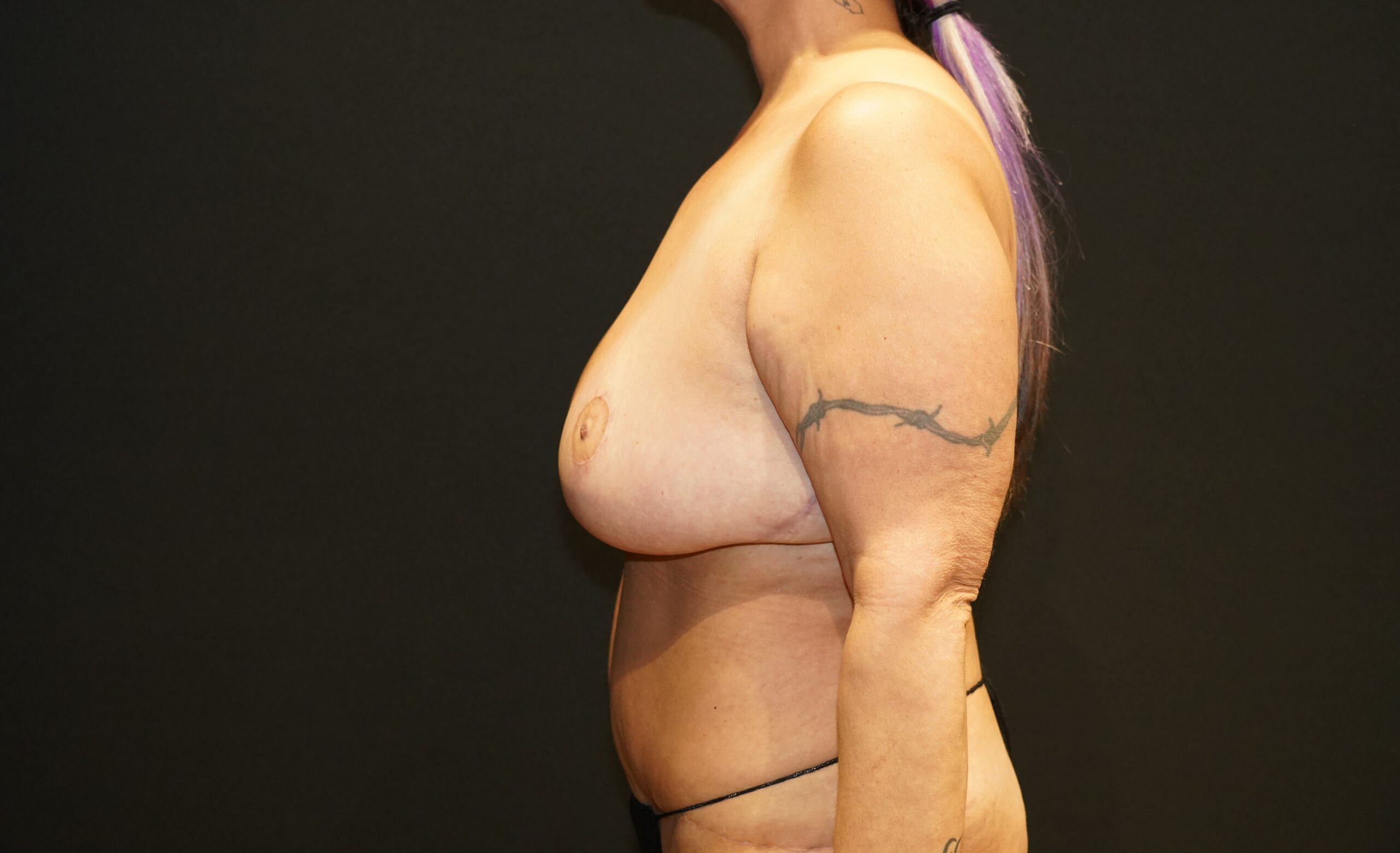 Case--9550 | Before Breast Lift/Mastopexy 2