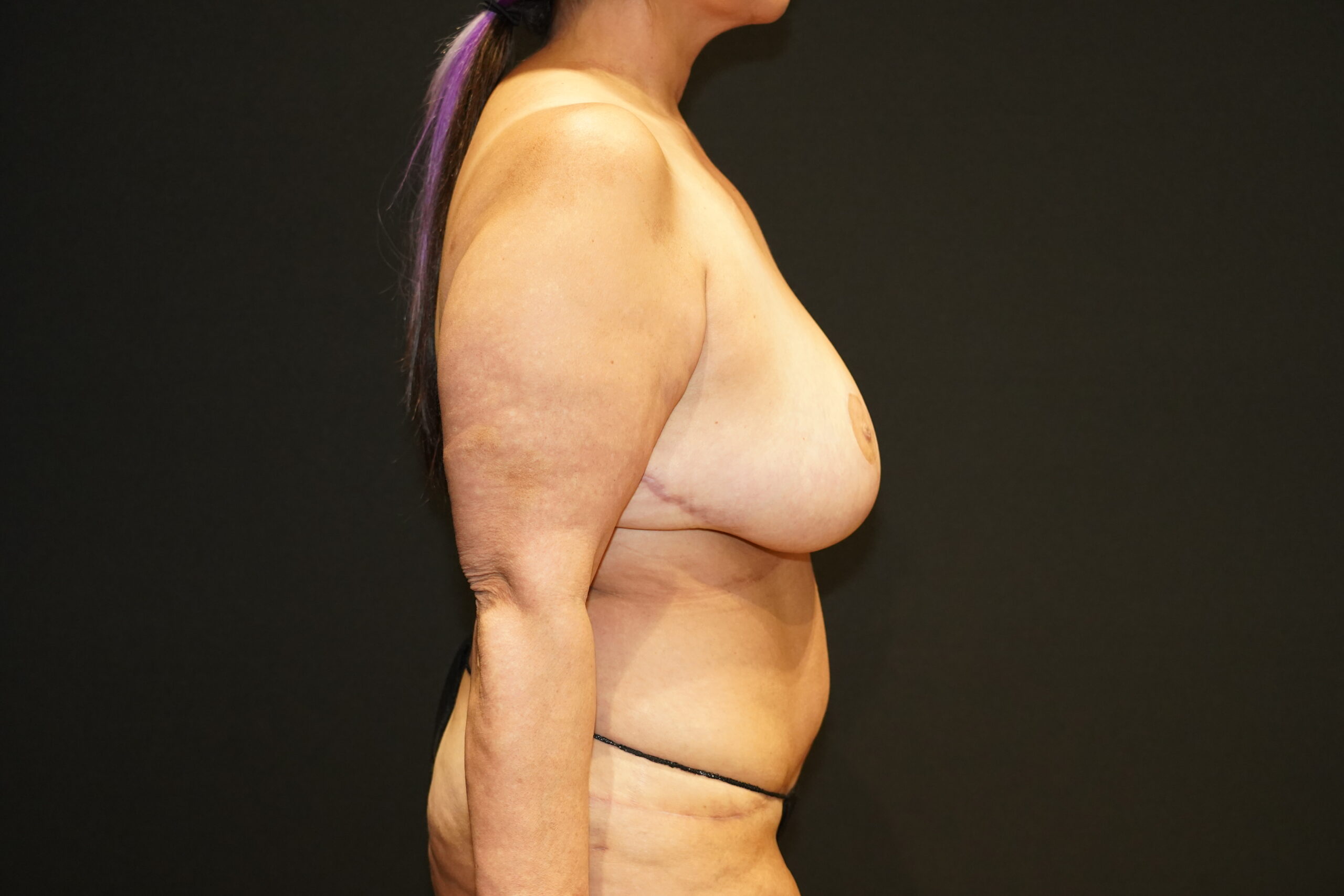 Case--9550 | Before Breast Reduction