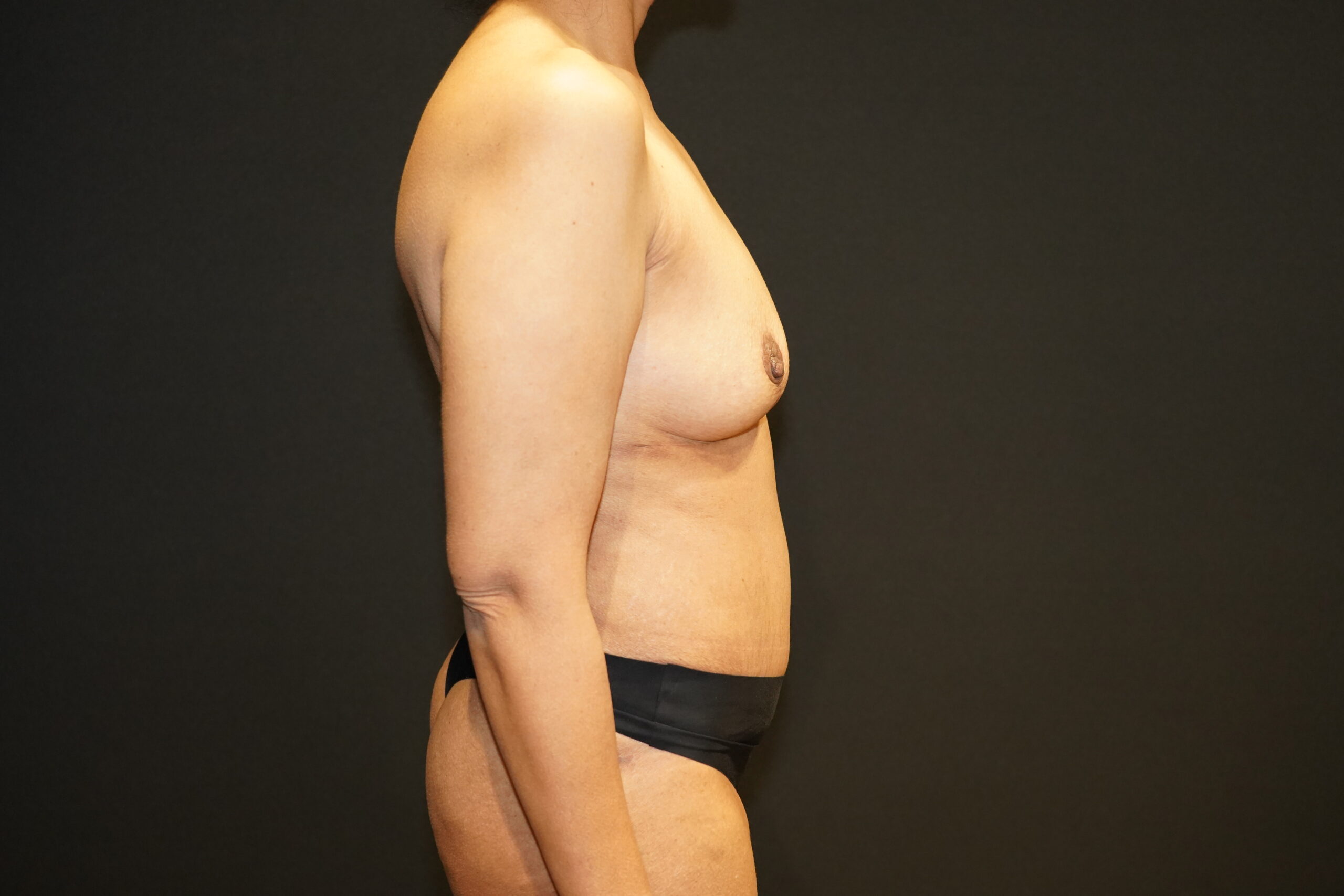 Case--6820 | After Breast Lift/Mastopexy 2