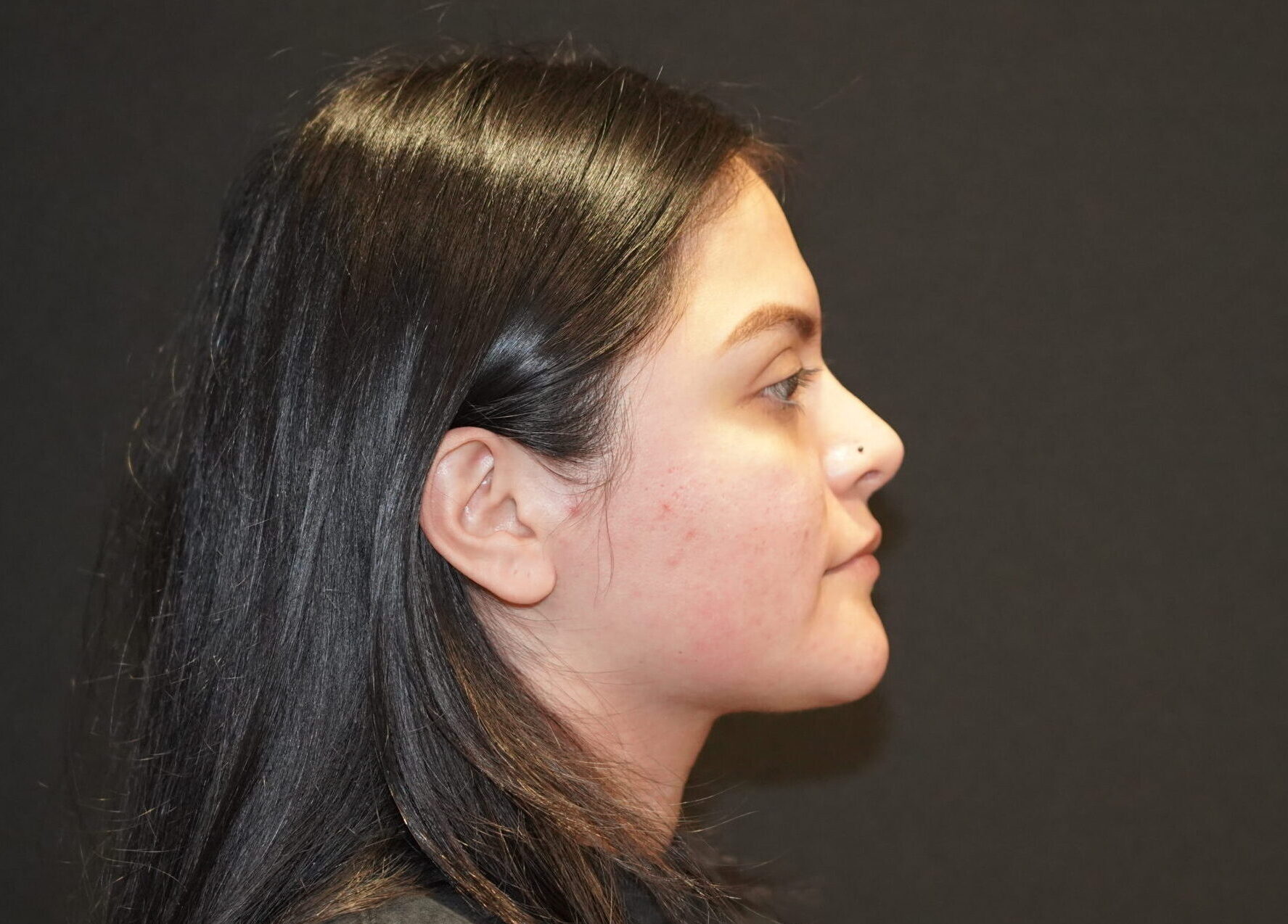 After photo - 90° view