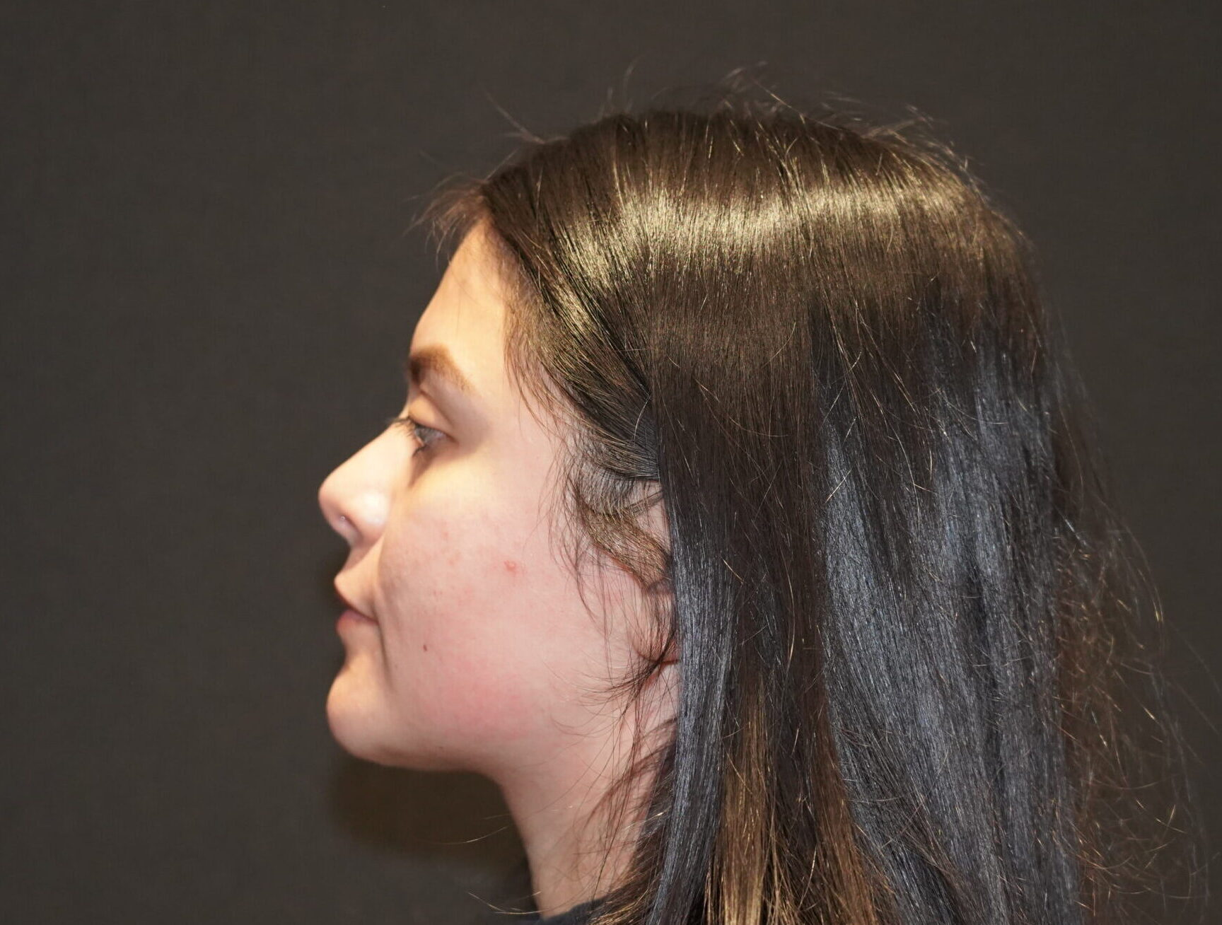 After photo - -90° view