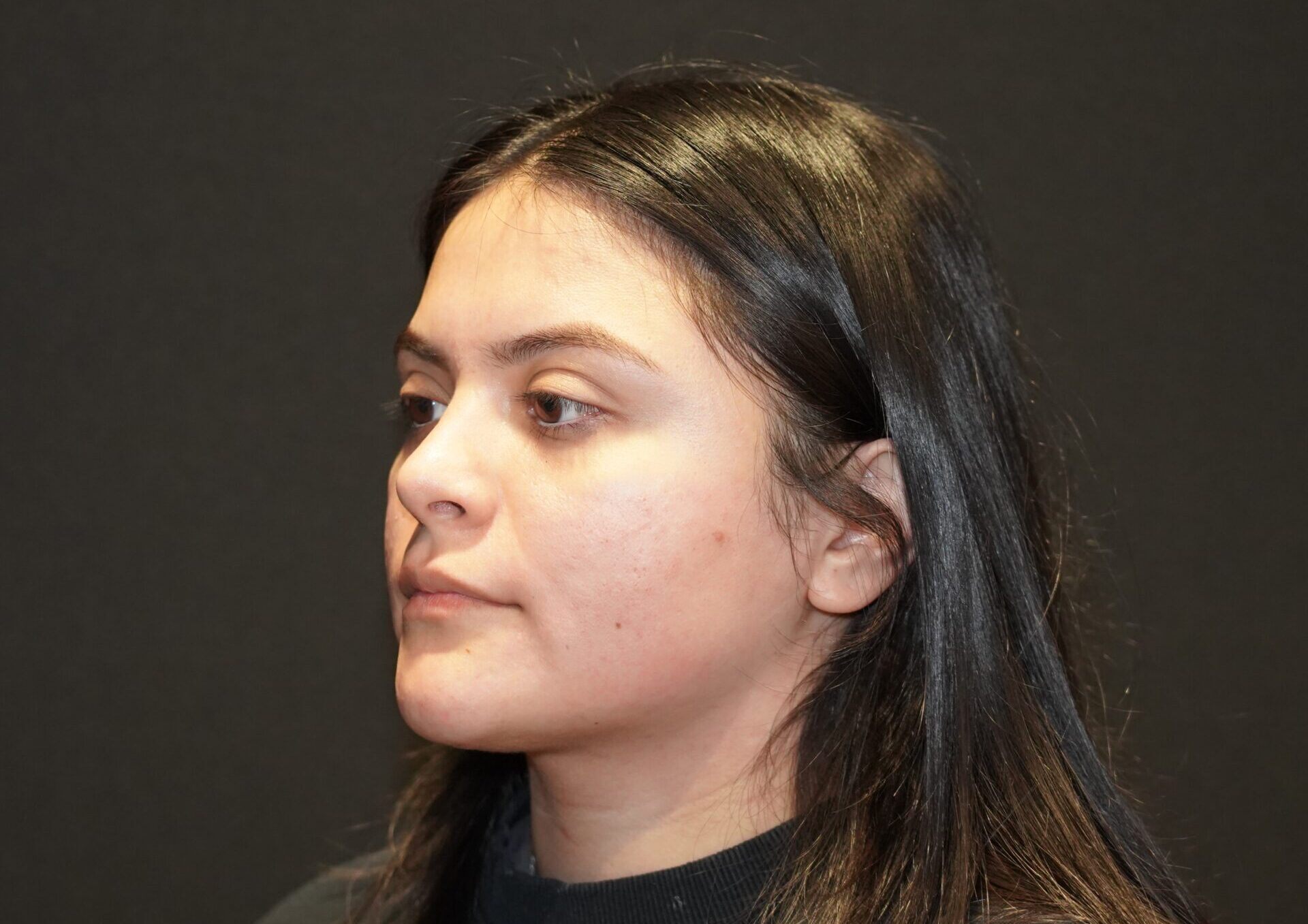 After photo - -45° view