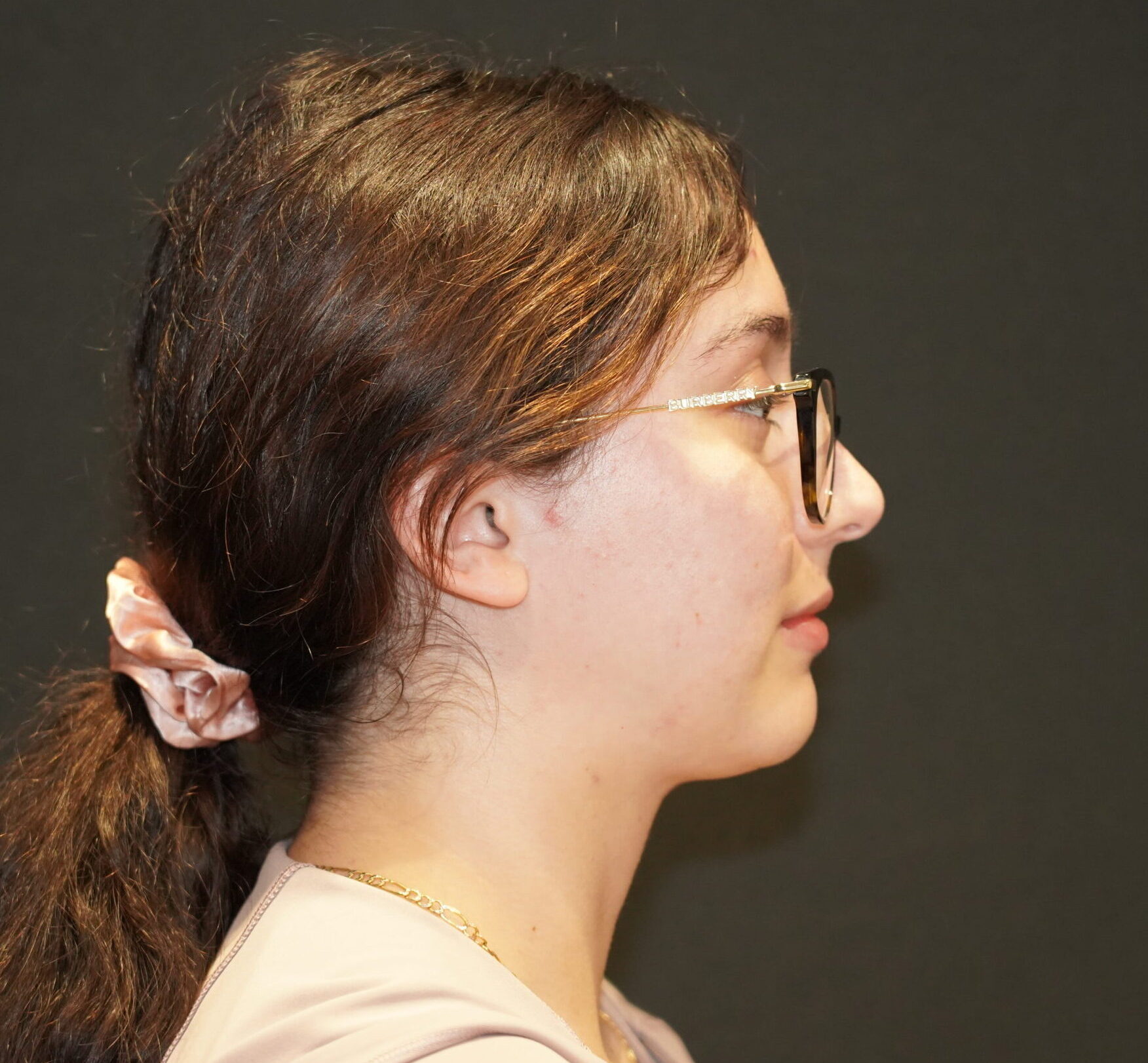 After photo - 90° view