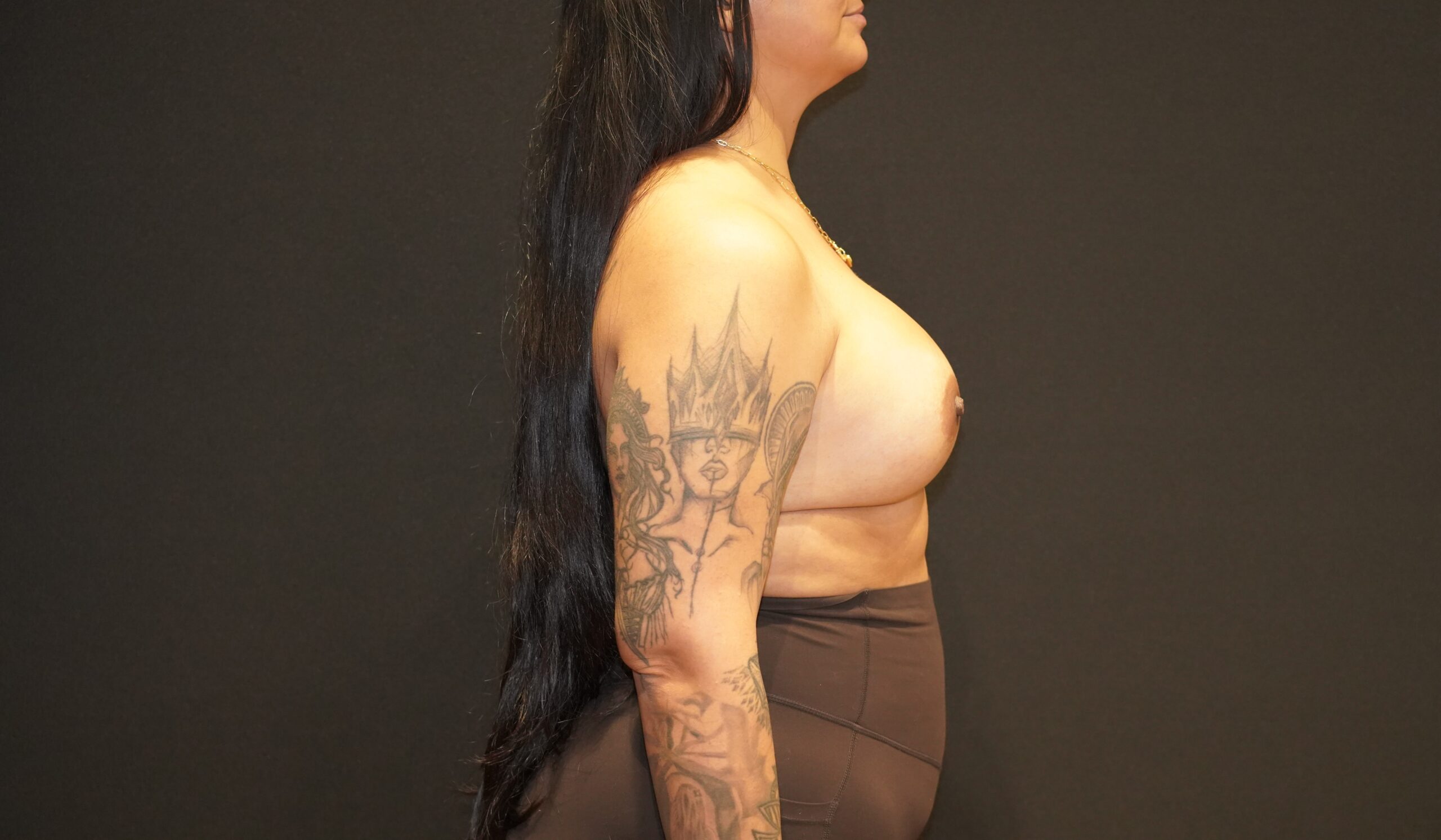 Case--7240 | After Breast Augmentation 5
