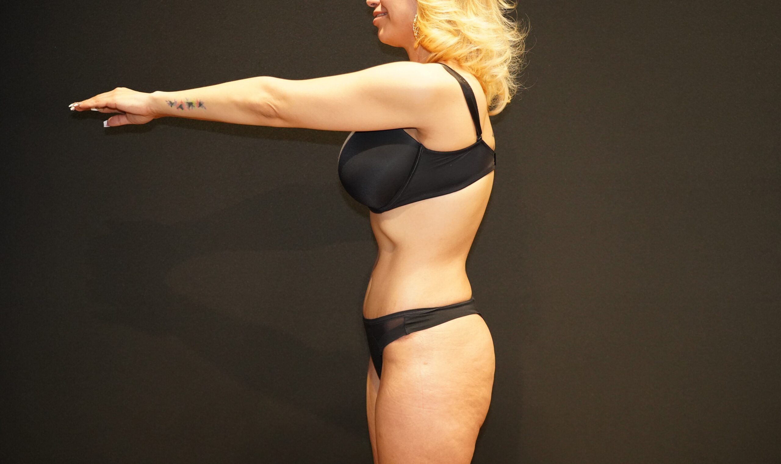 Case--9979 | After Tummy Tuck 3