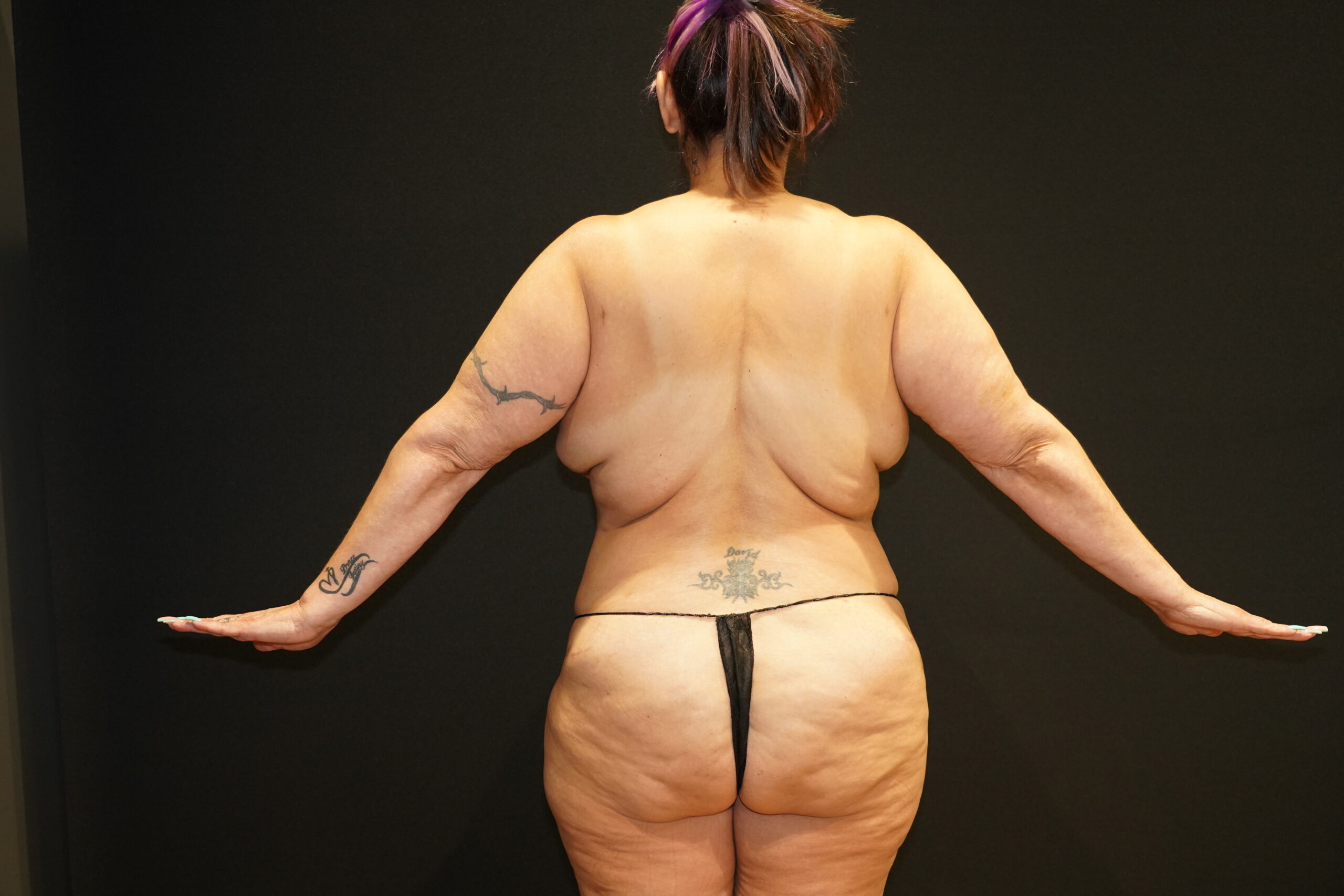 Case--9550 | Before Breast Lift/Mastopexy 5