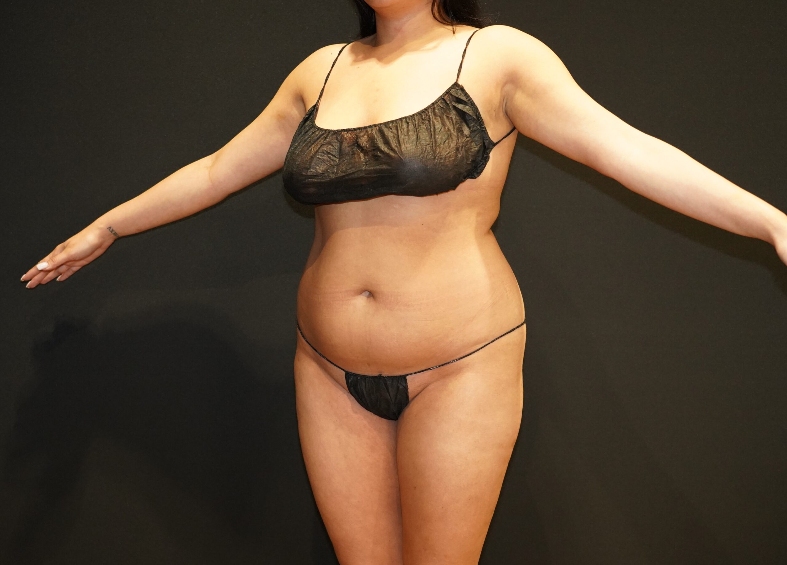 Case--7681 | Before Body Liposuction & Contouring 5