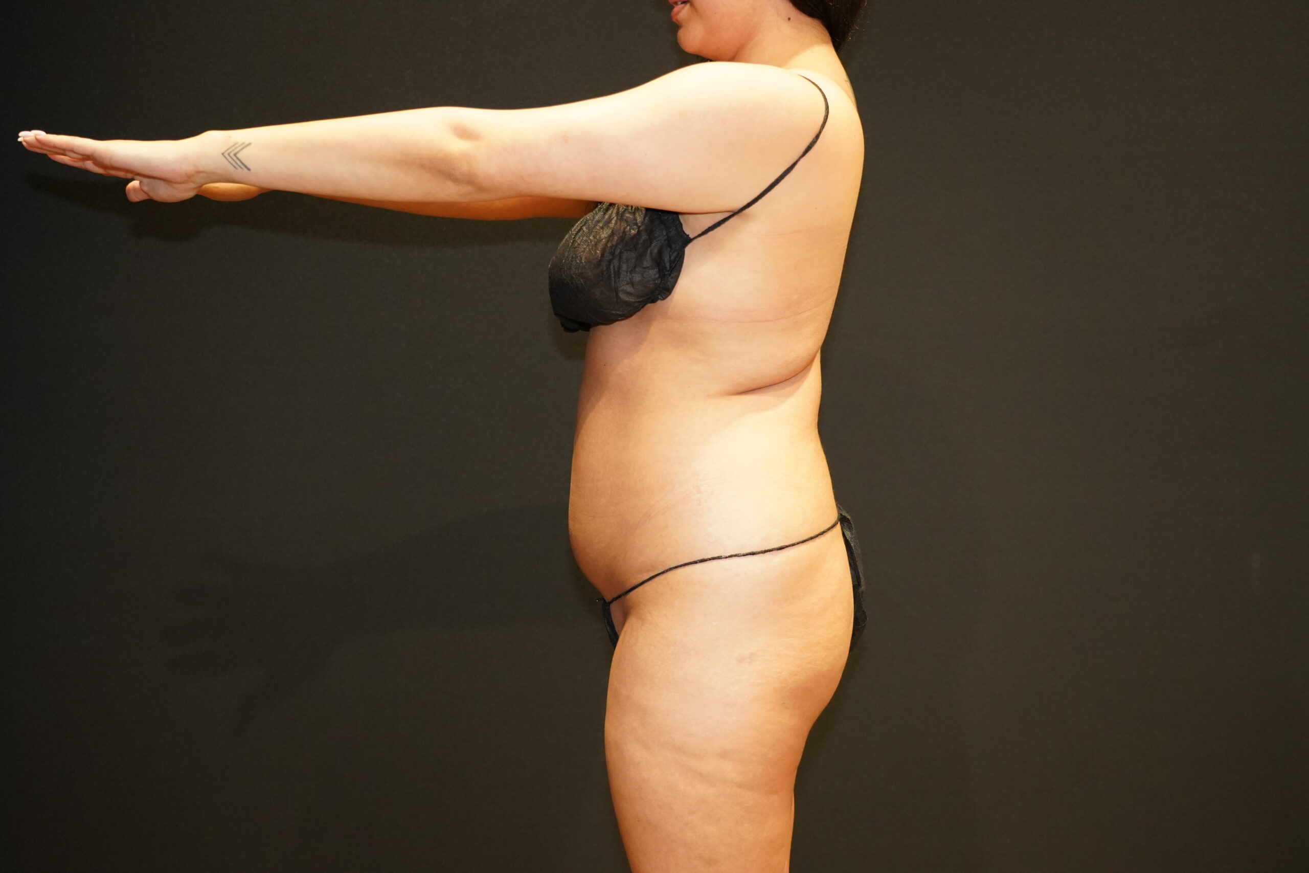 Case--7681 | Before Body Liposuction & Contouring 6