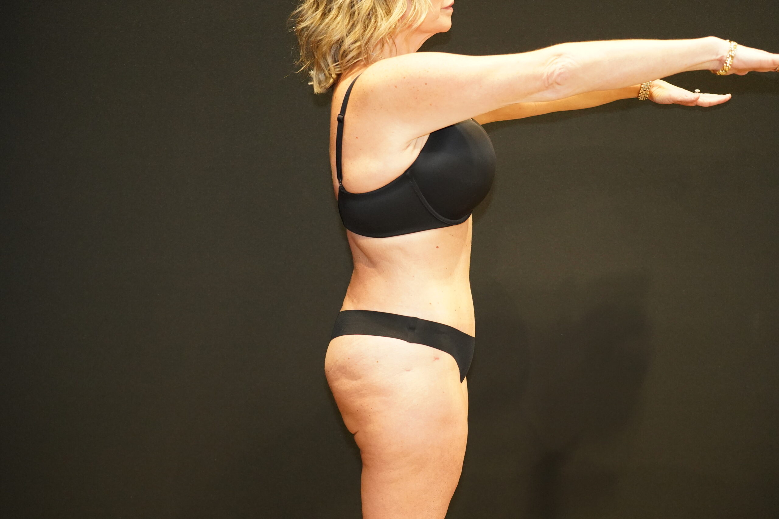 Case--8068 | After Tummy Tuck 3